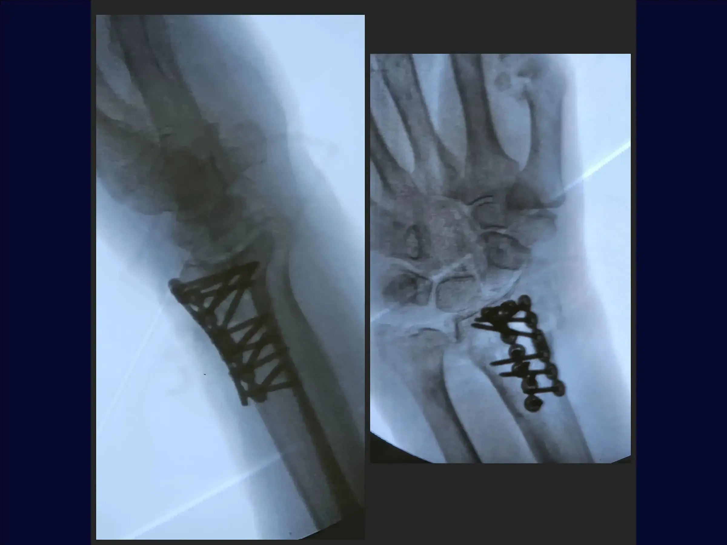 Dorsal Barton's Fracture of the Radius