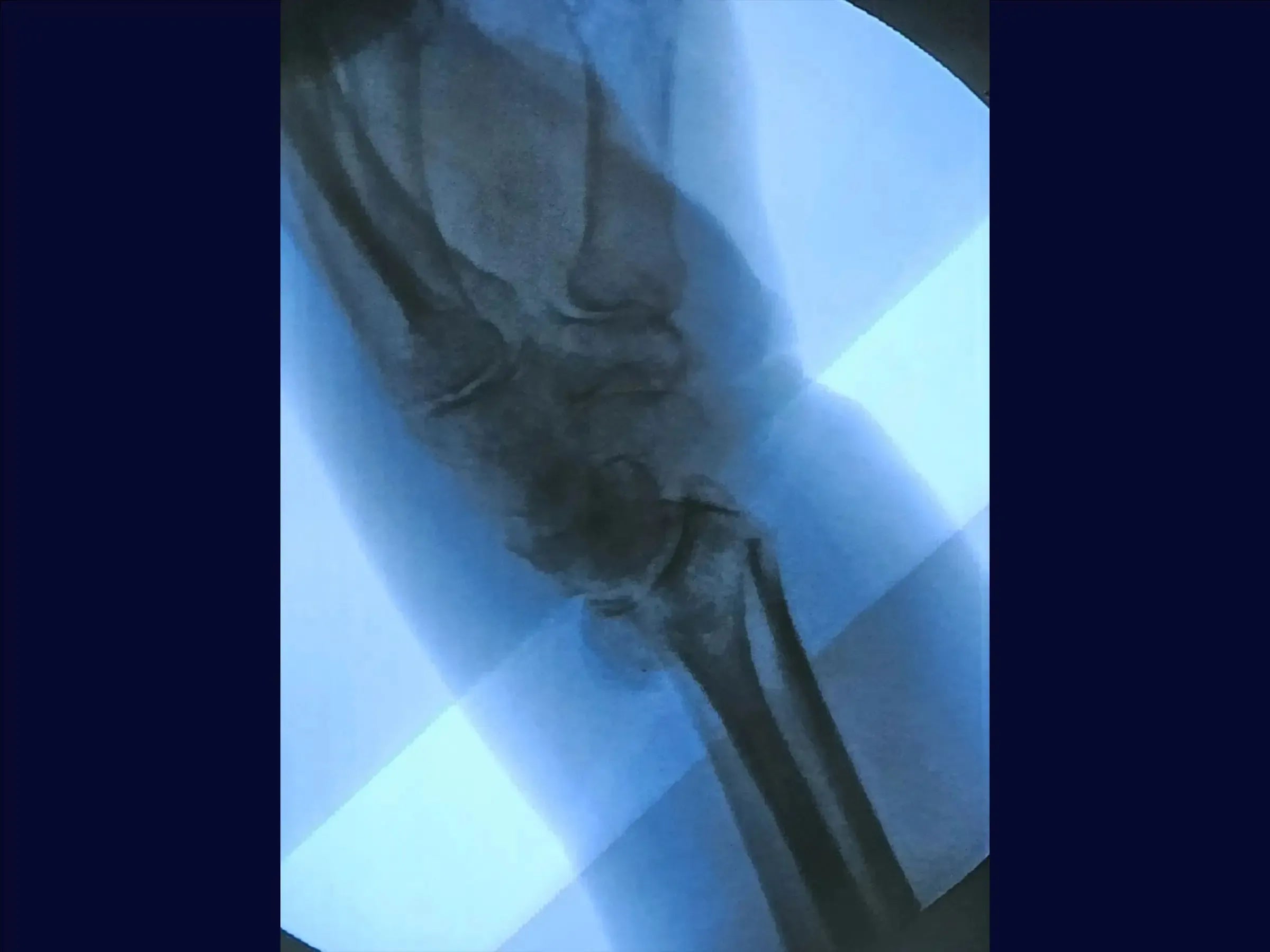 Dorsal Barton's Fracture of the Radius