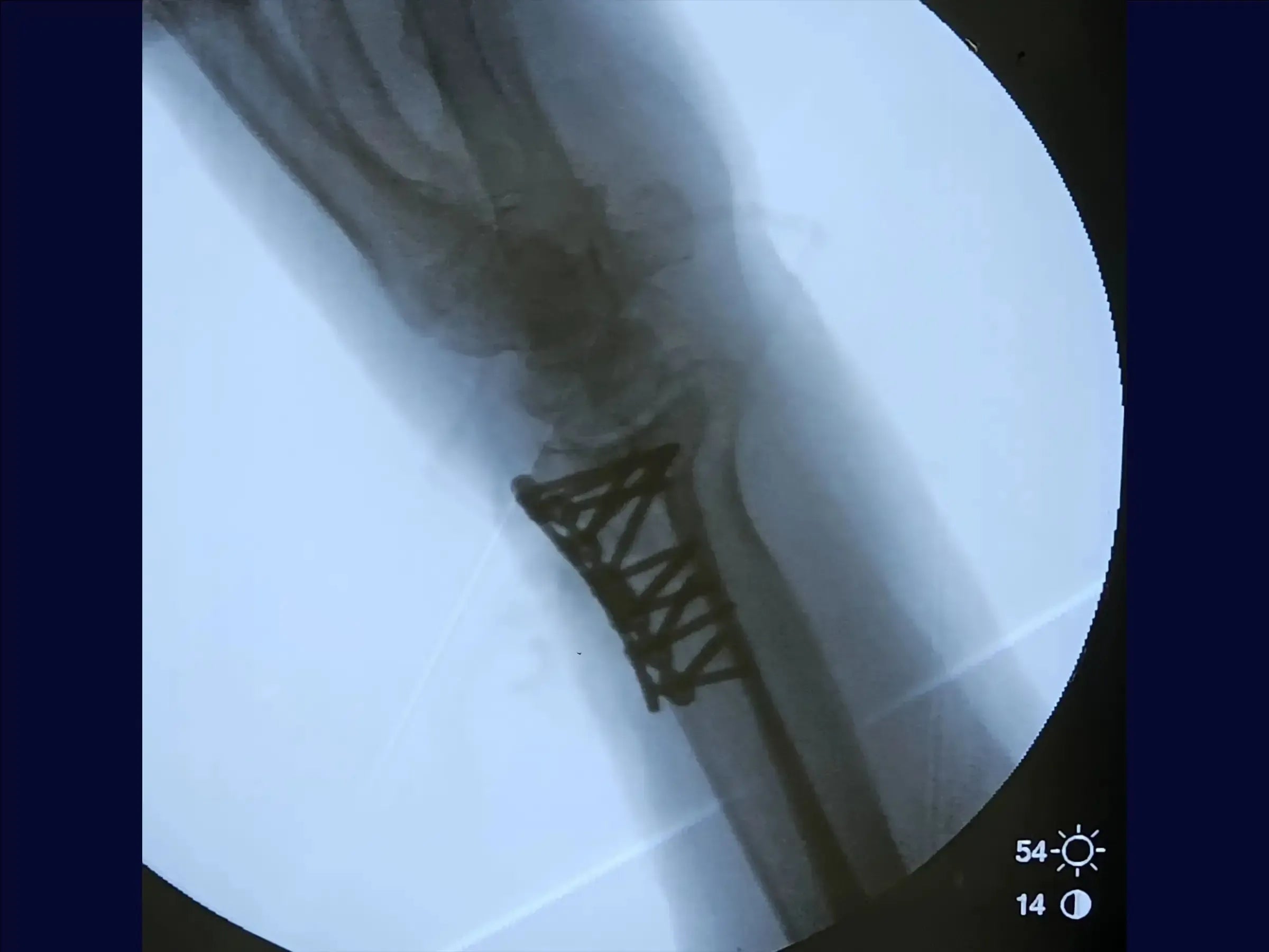 Dorsal Barton's Fracture of the Radius