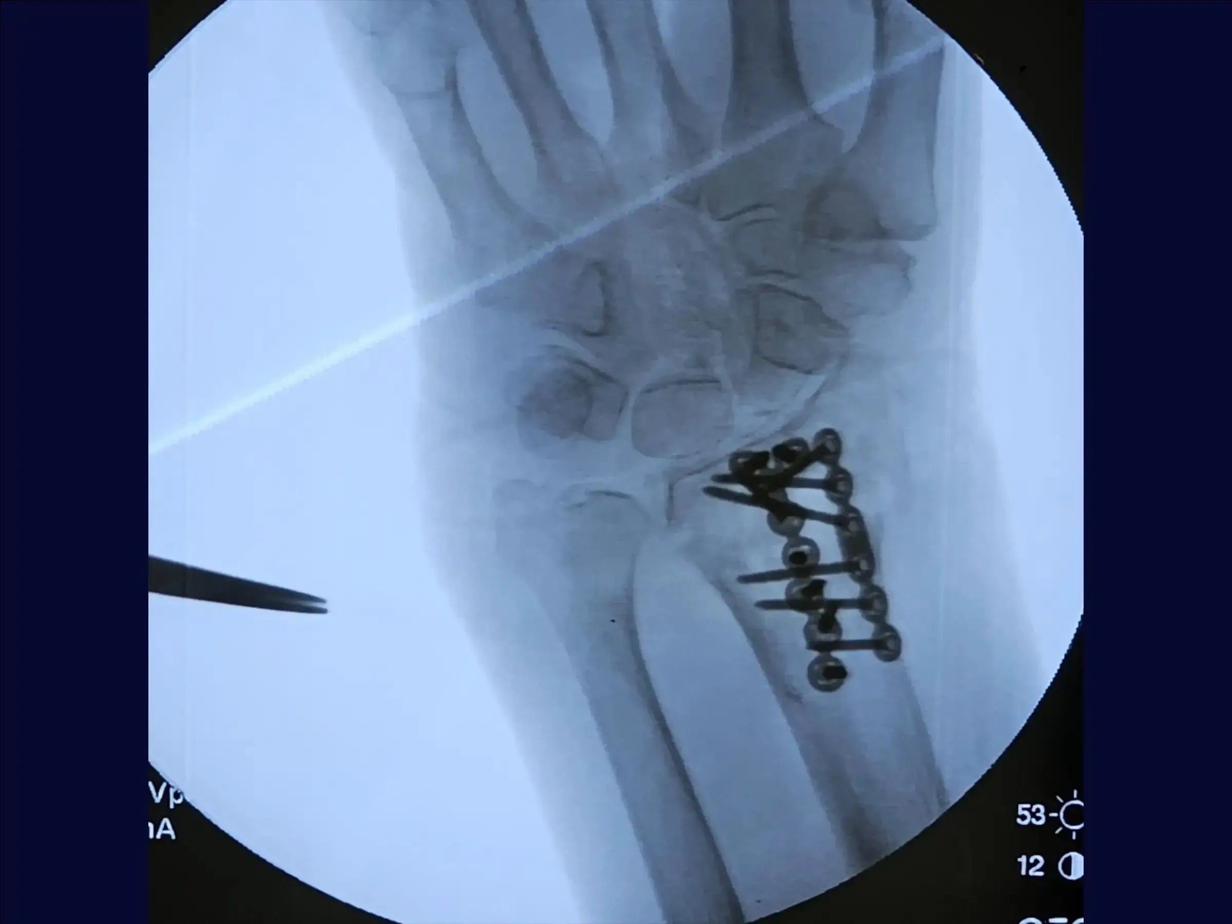 Dorsal Barton's Fracture of the Radius