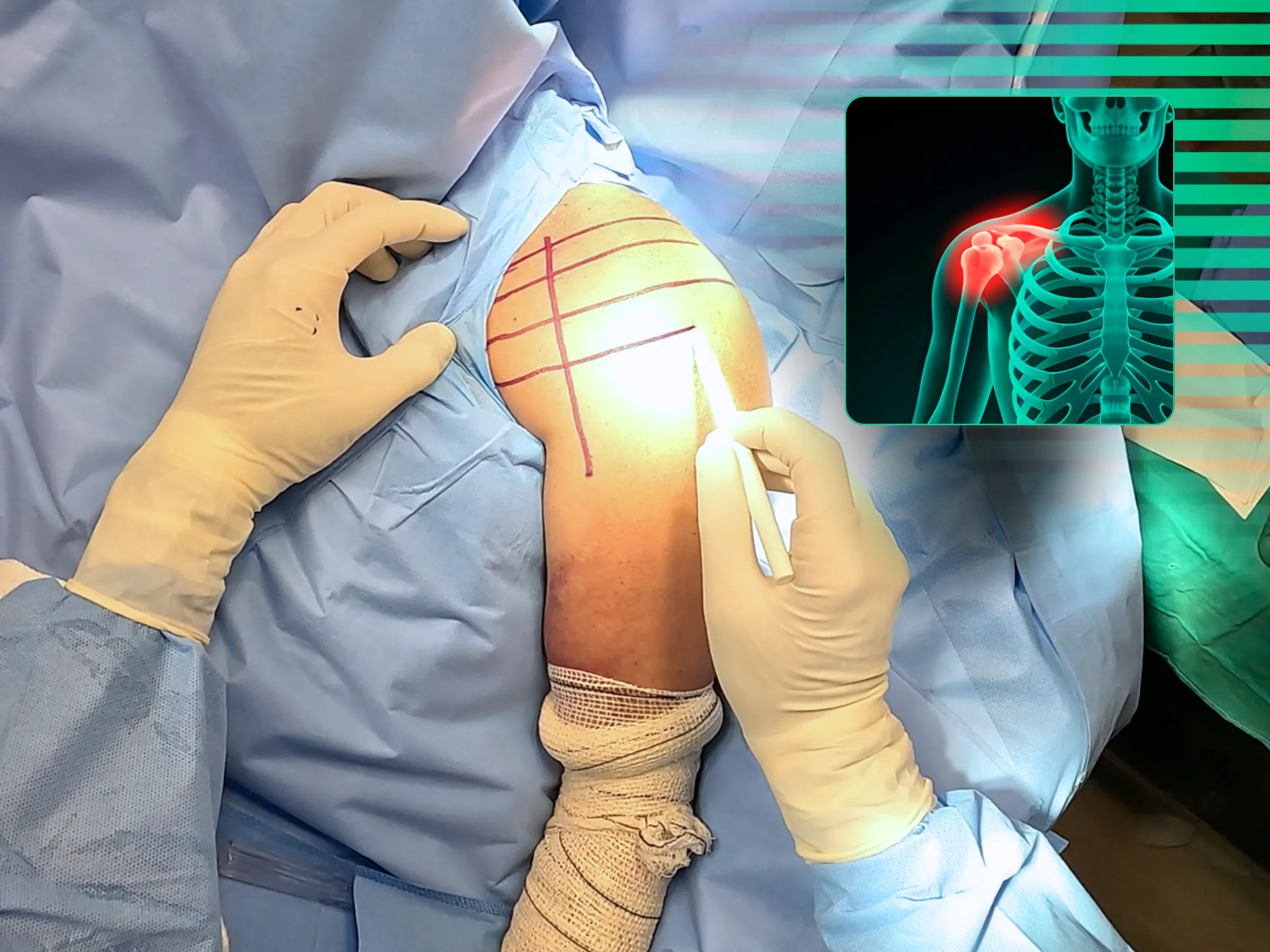 Fratura do Úmero Proximal em Quatro Partes (Acesso Deltopeitoral)