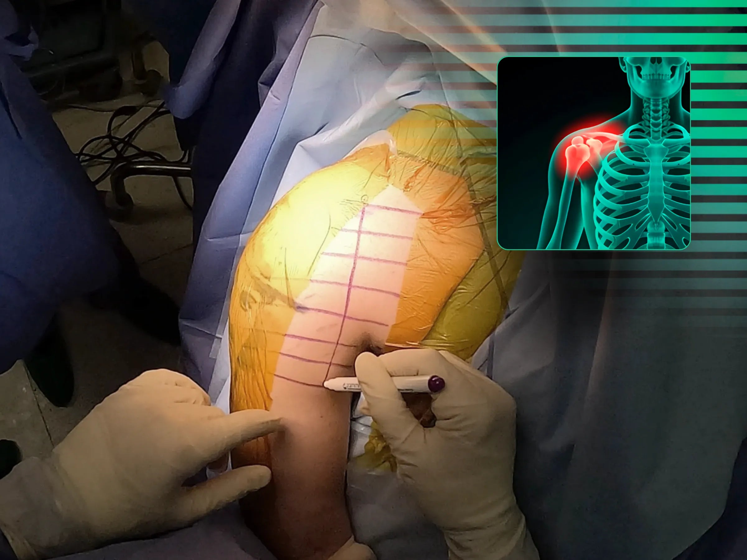 Fijación de fractura glenoidea (segmento de procedimiento combinado)