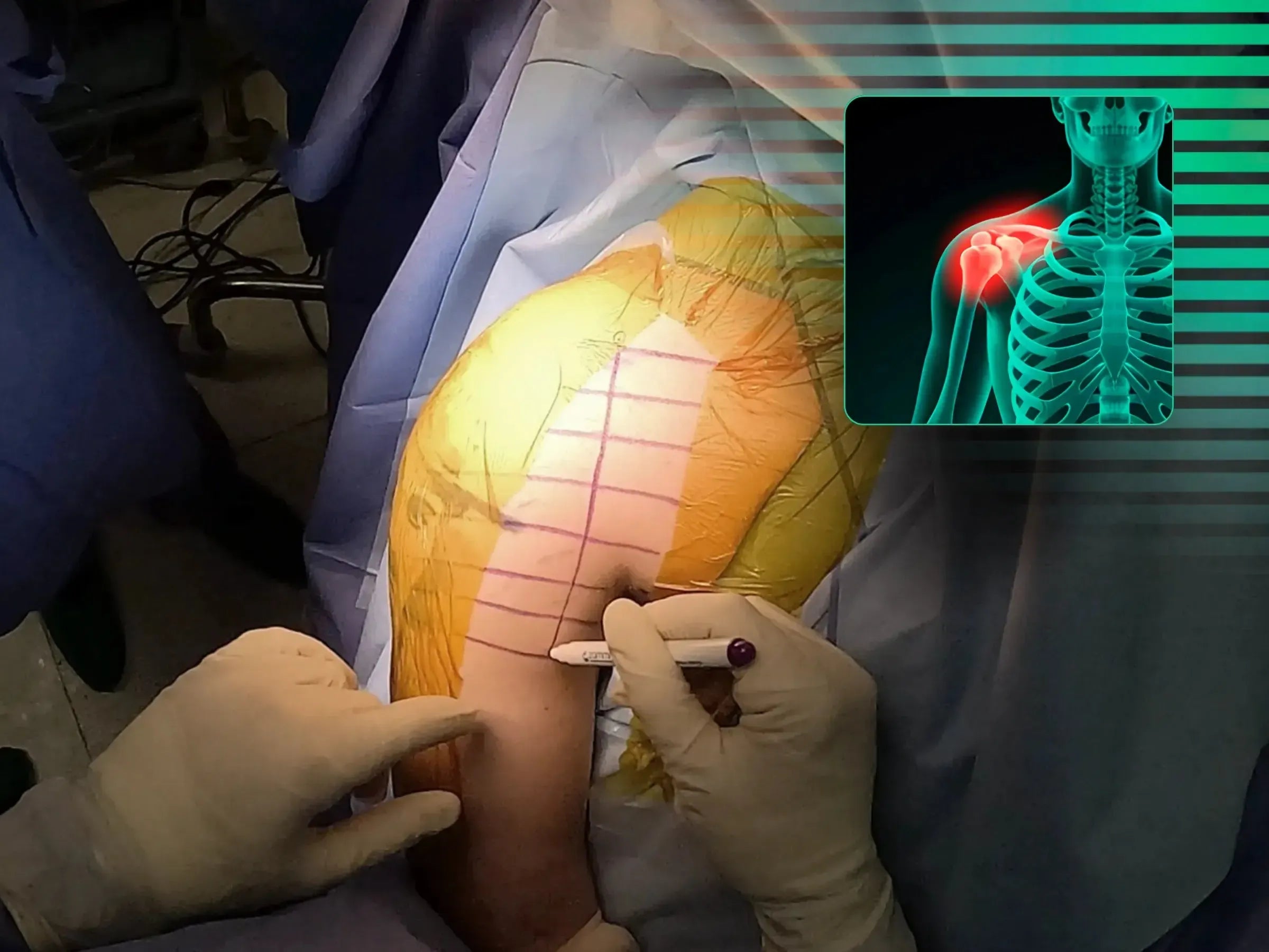 Fracture Fixation of the Glenoid (Combined Procedure Segment)