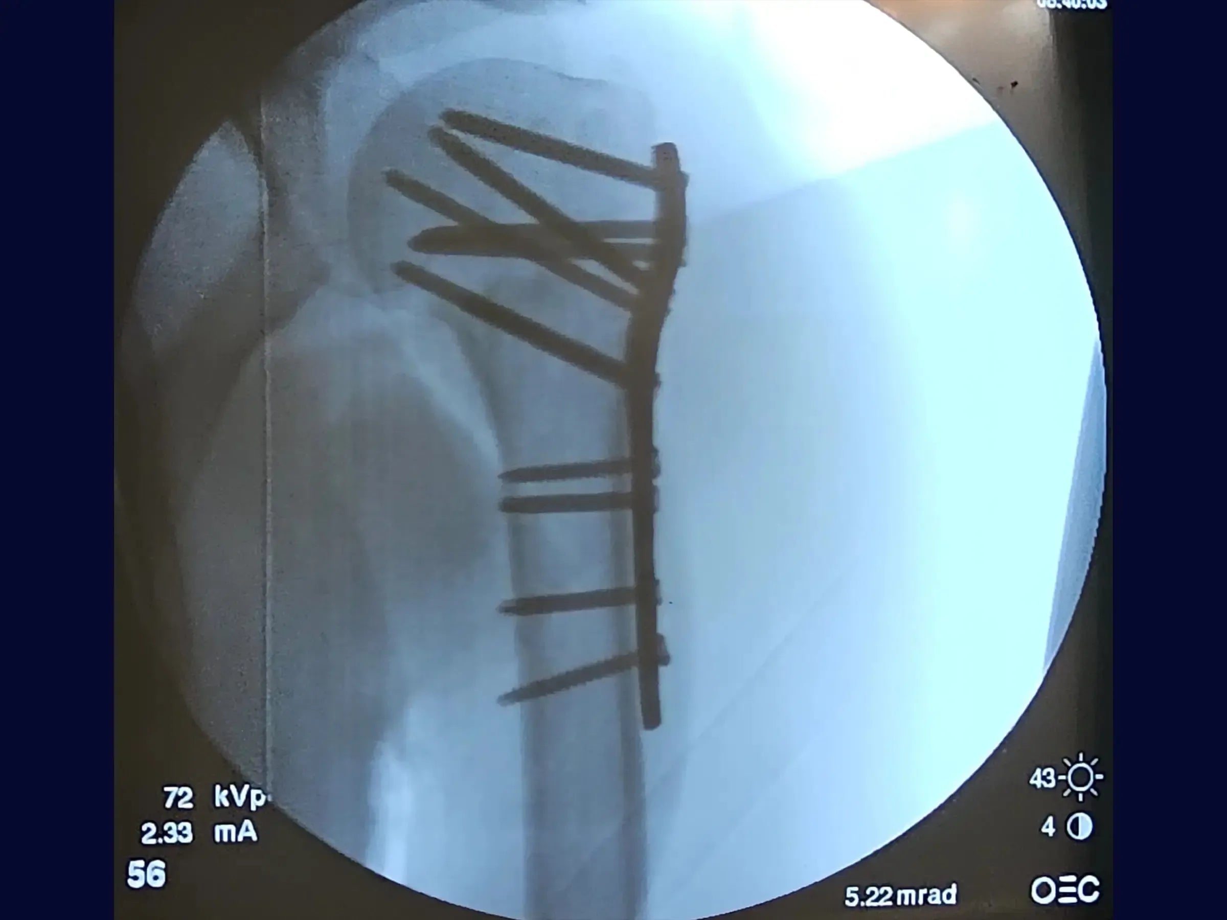 Four-Part Proximal Humerus Fracture (Deltopectoral Approach)