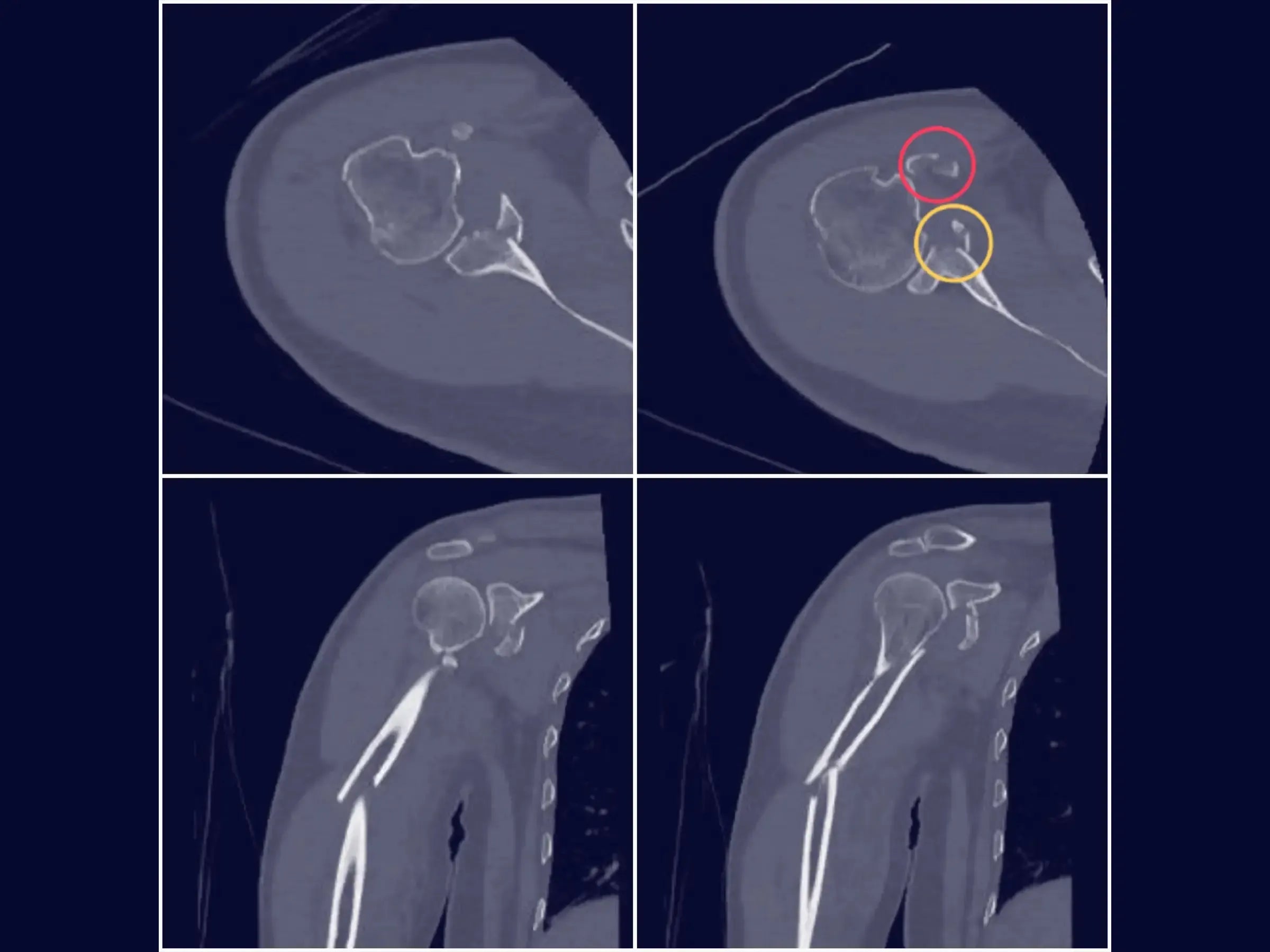 Fracture Fixation of the Glenoid (Combined Procedure Segment)