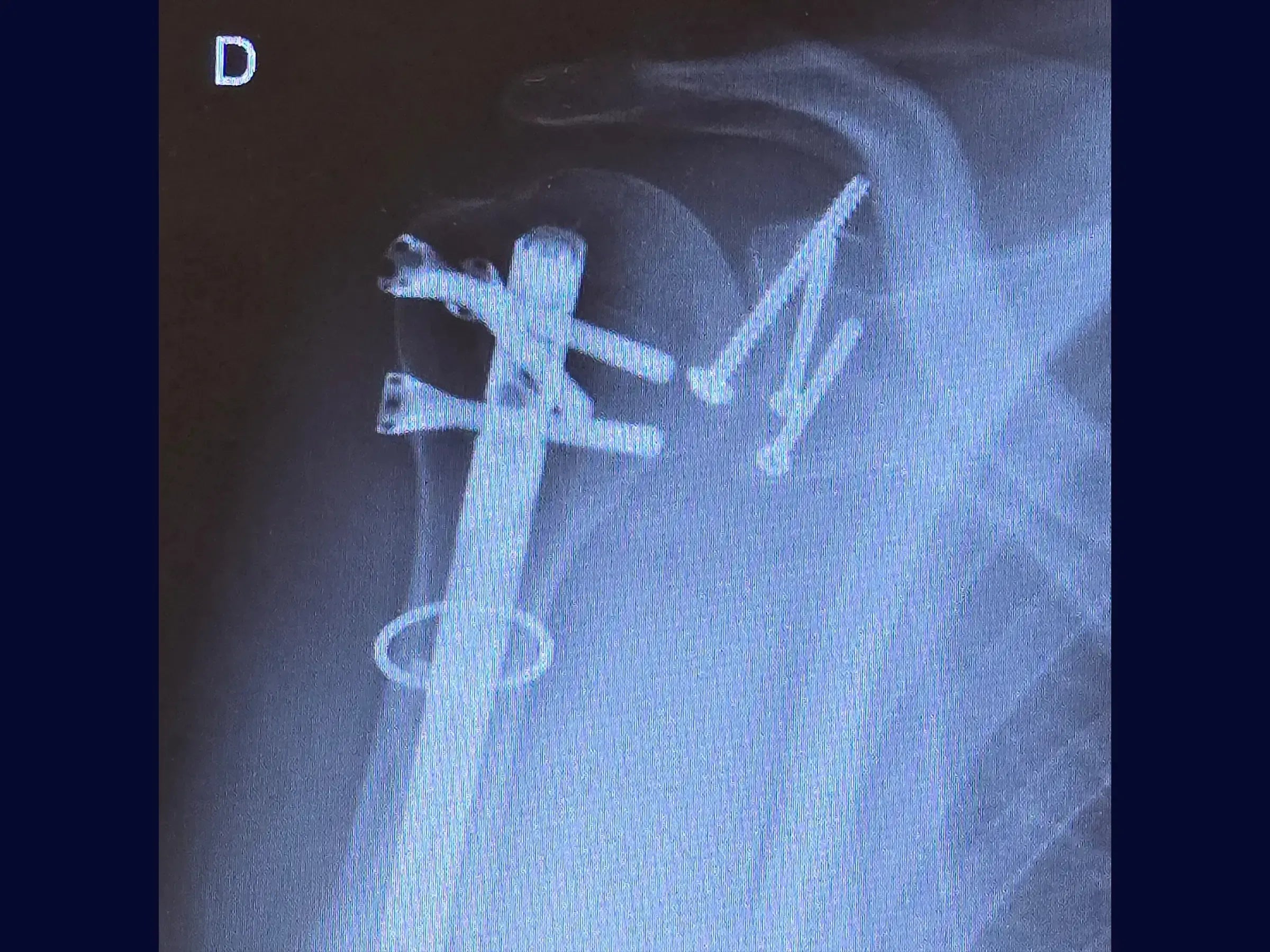 Fracture Fixation of the Glenoid (Combined Procedure Segment)