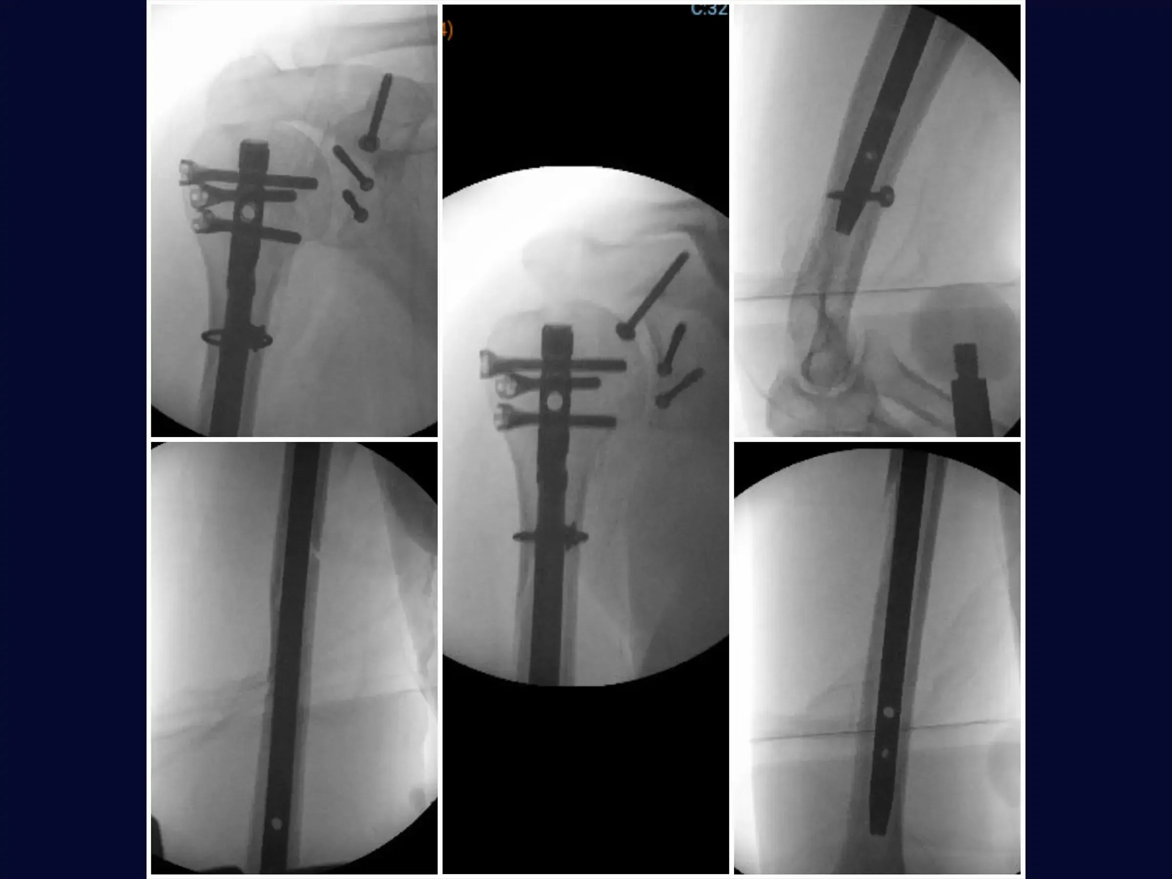 Fracture Fixation of the Glenoid (Combined Procedure Segment)