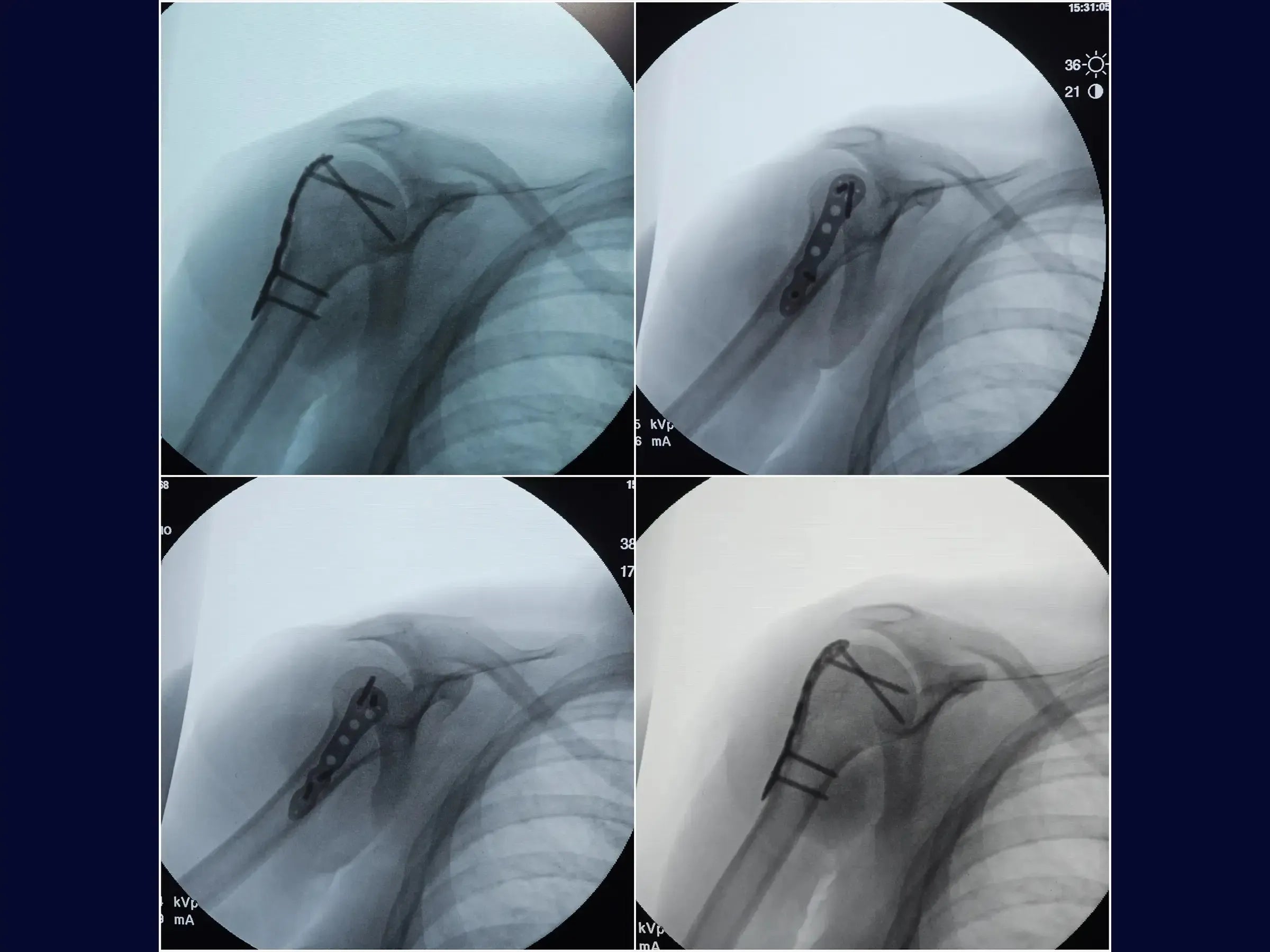 Fracture of the Greater Tuberosity of the Humerus with Deltopectoral Approach
