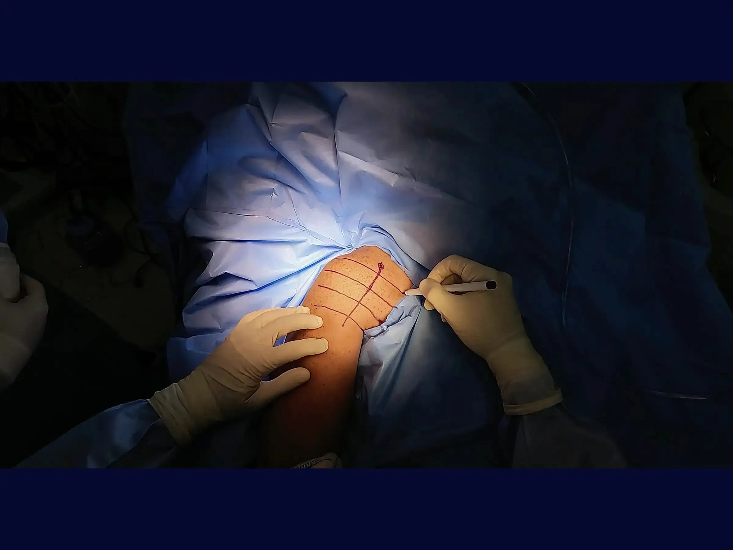 Fracture of the Greater Tuberosity of the Humerus with Deltopectoral Approach