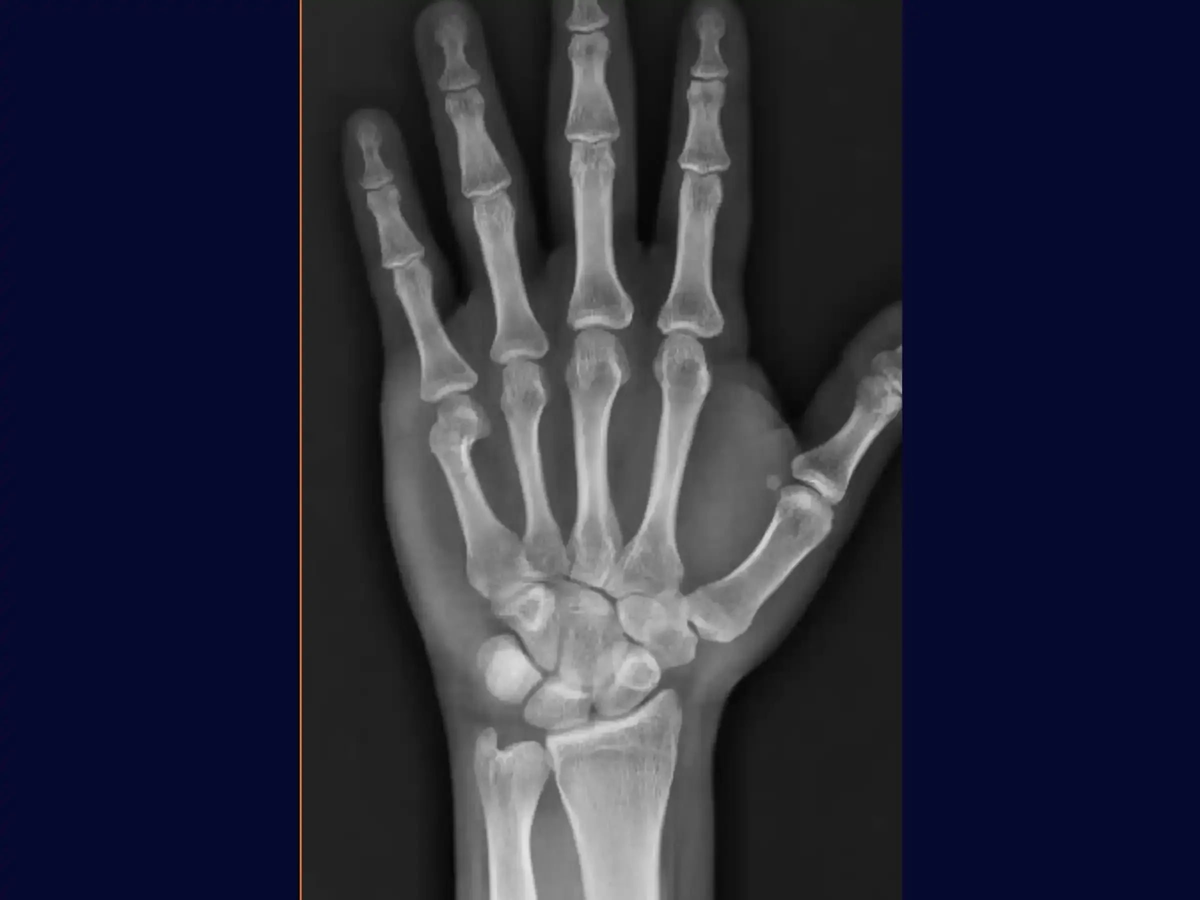 Fracture of the Neck of the Fifth Metacarpal (Boxer's Fracture)