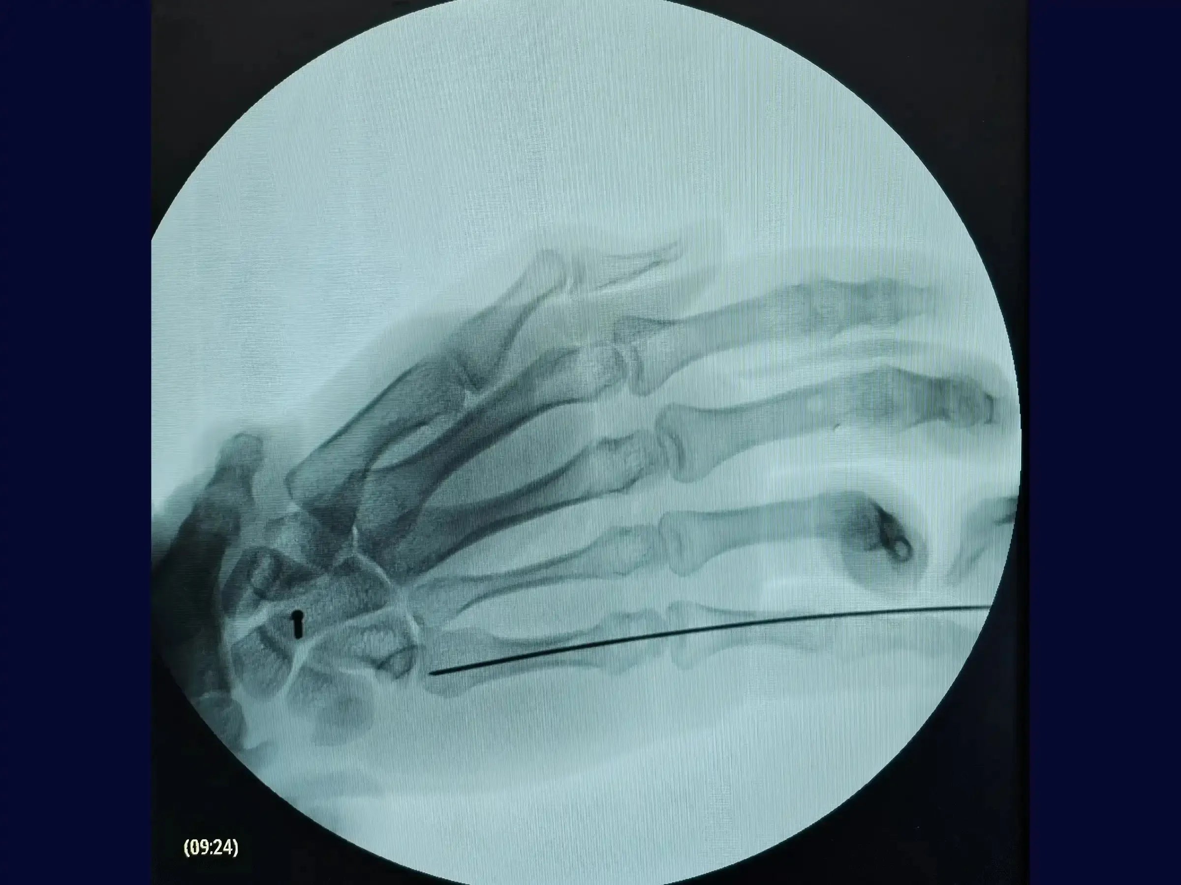 Fracture of the Neck of the Fifth Metacarpal (Boxer's Fracture)
