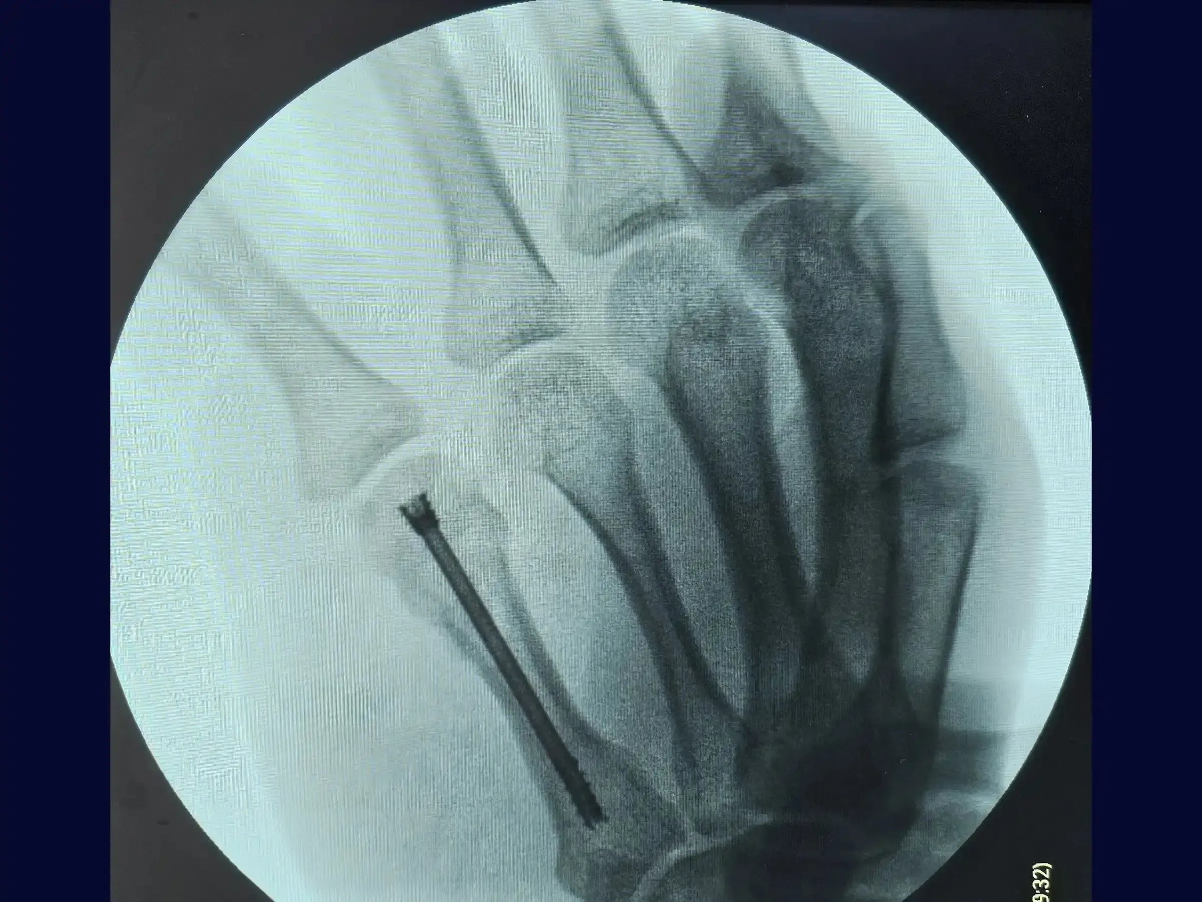 Fracture of the Neck of the Fifth Metacarpal (Boxer's Fracture)