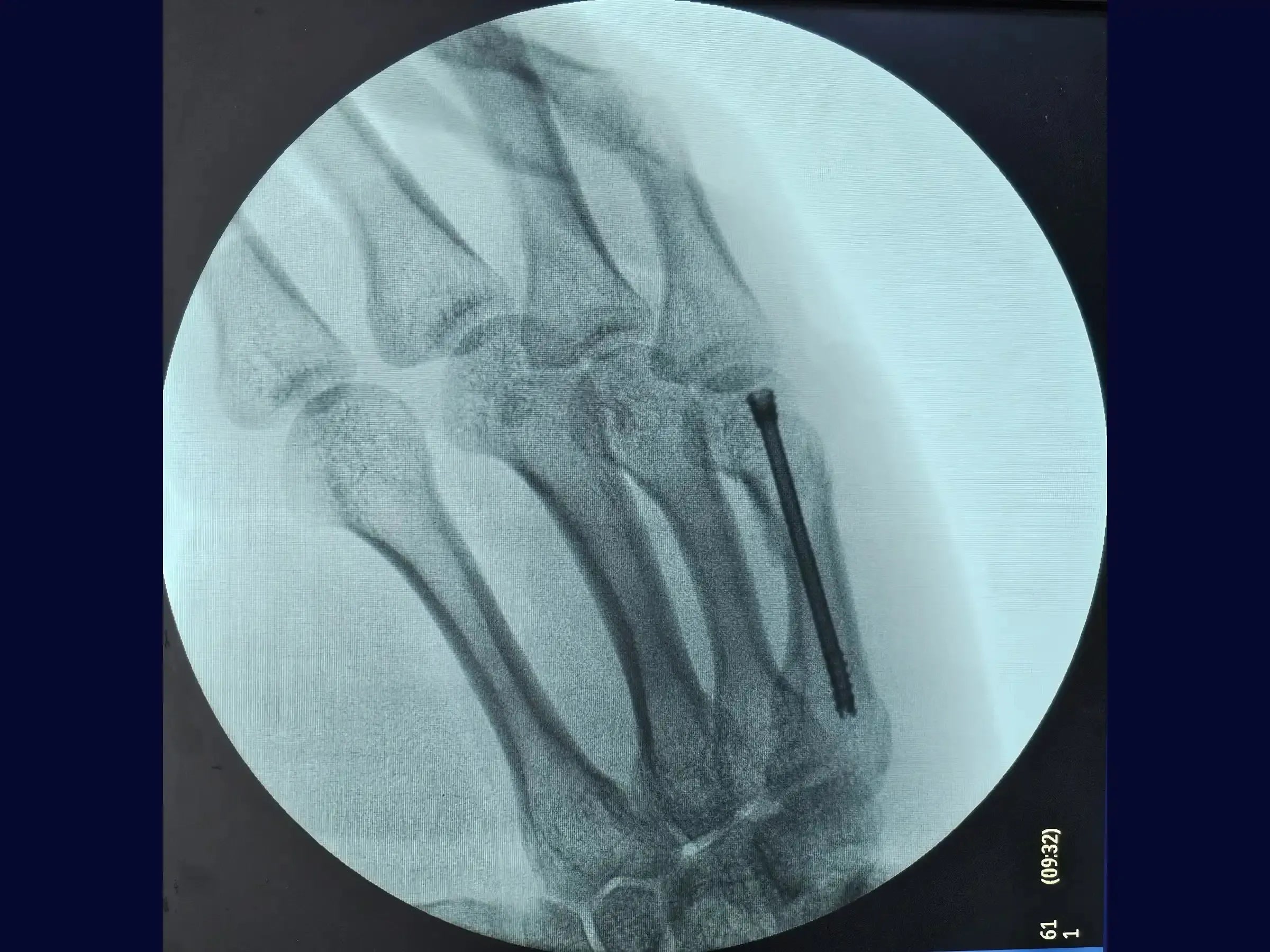 Fracture of the Neck of the Fifth Metacarpal (Boxer's Fracture)
