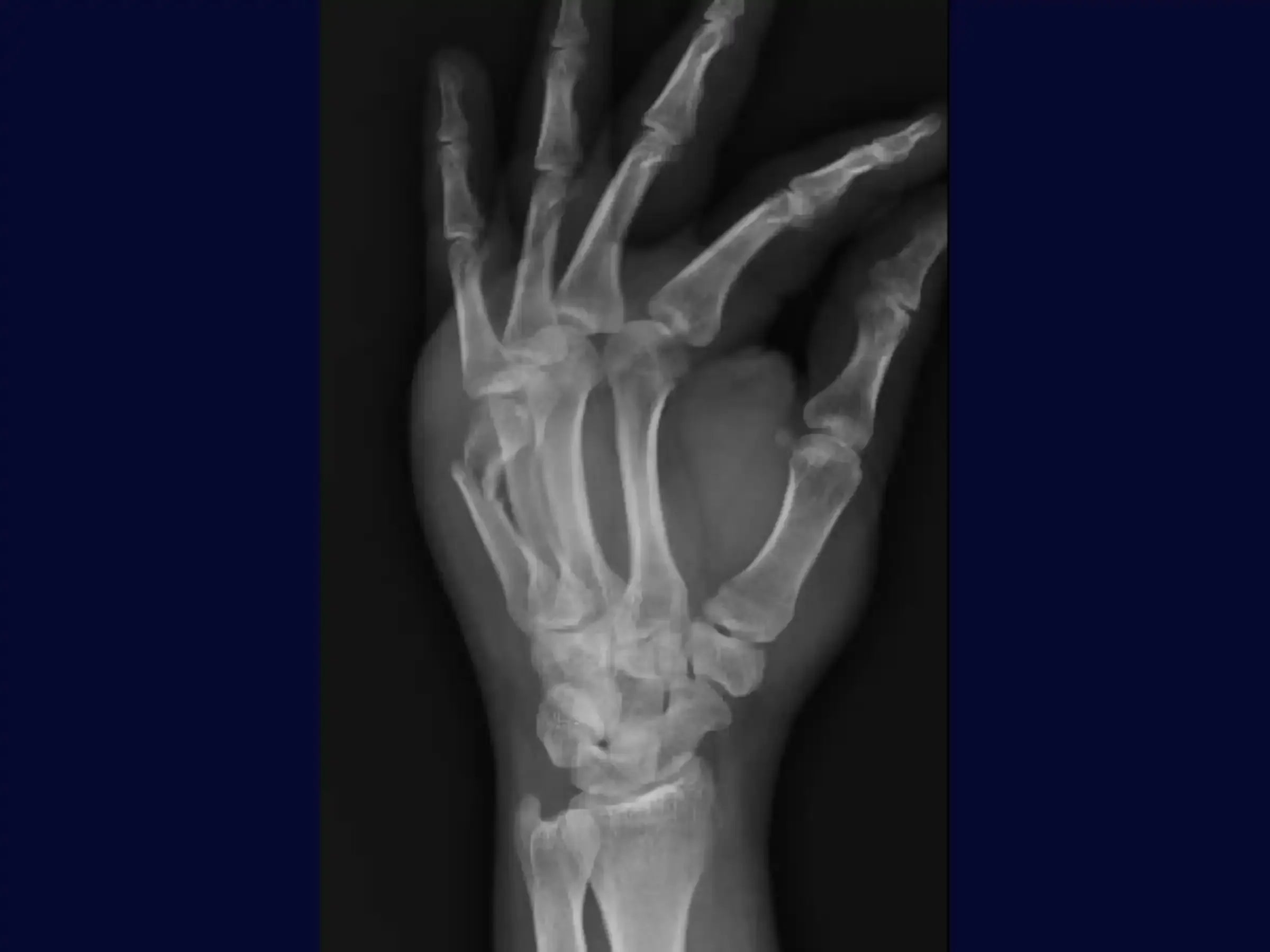 Fracture of the Neck of the Fifth Metacarpal (Boxer's Fracture)