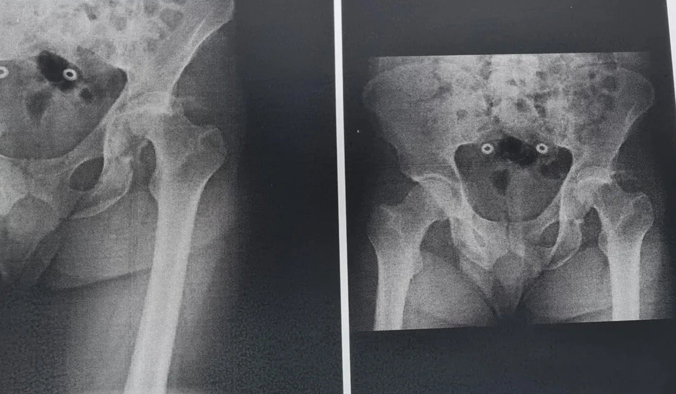 Fracture of the Posterior Acetabular Wall with Hip Dislocation