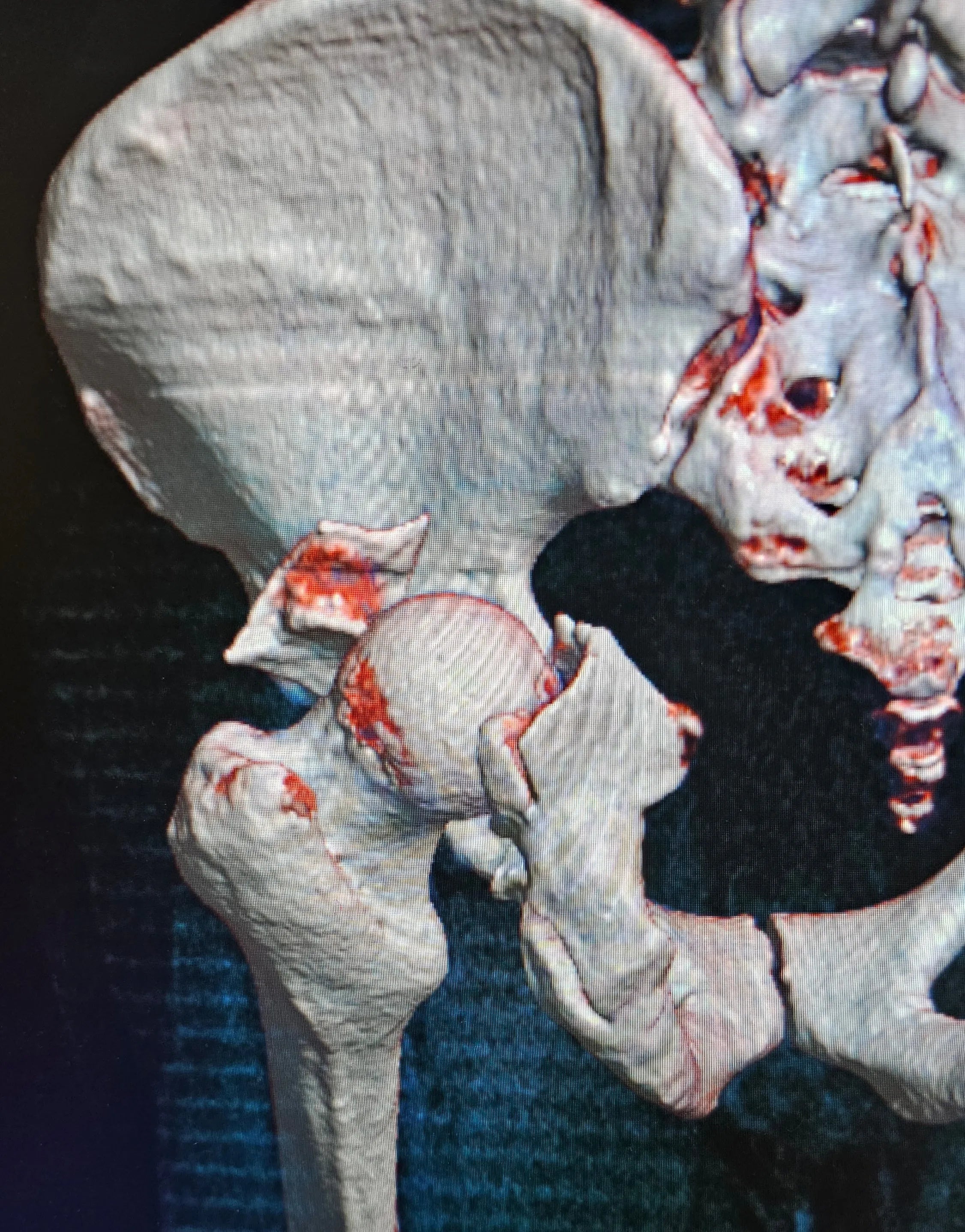 Fracture of the Posterior Acetabular Wall with Hip Dislocation
