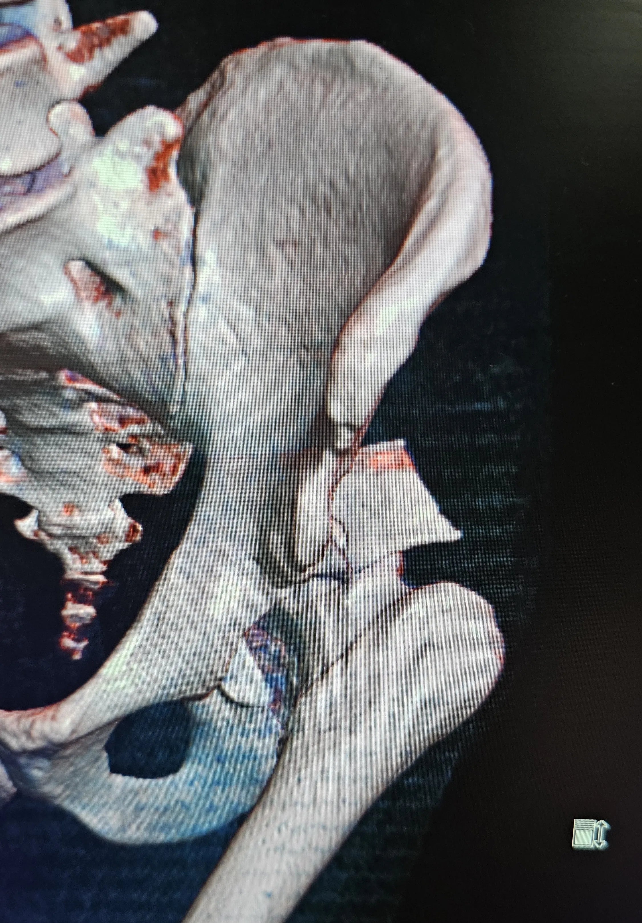 Fracture of the Posterior Acetabular Wall with Hip Dislocation