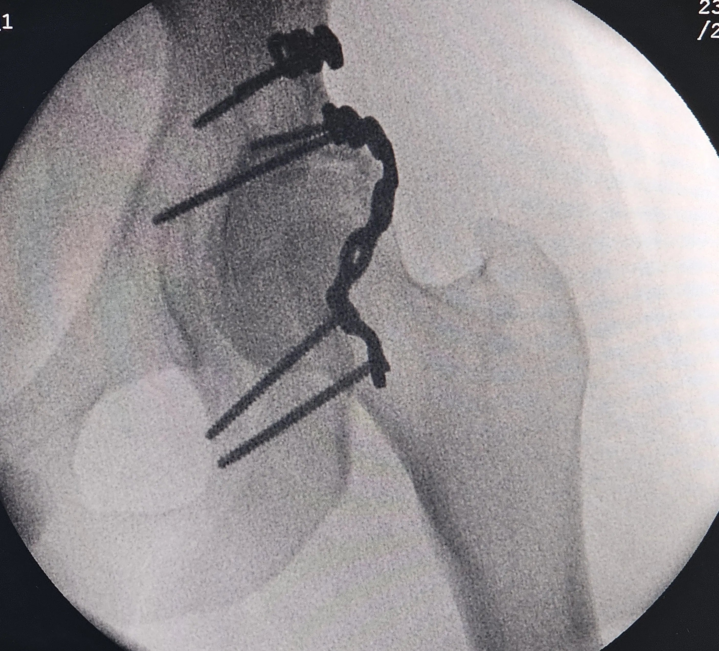 Fracture of the Posterior Acetabular Wall with Hip Dislocation