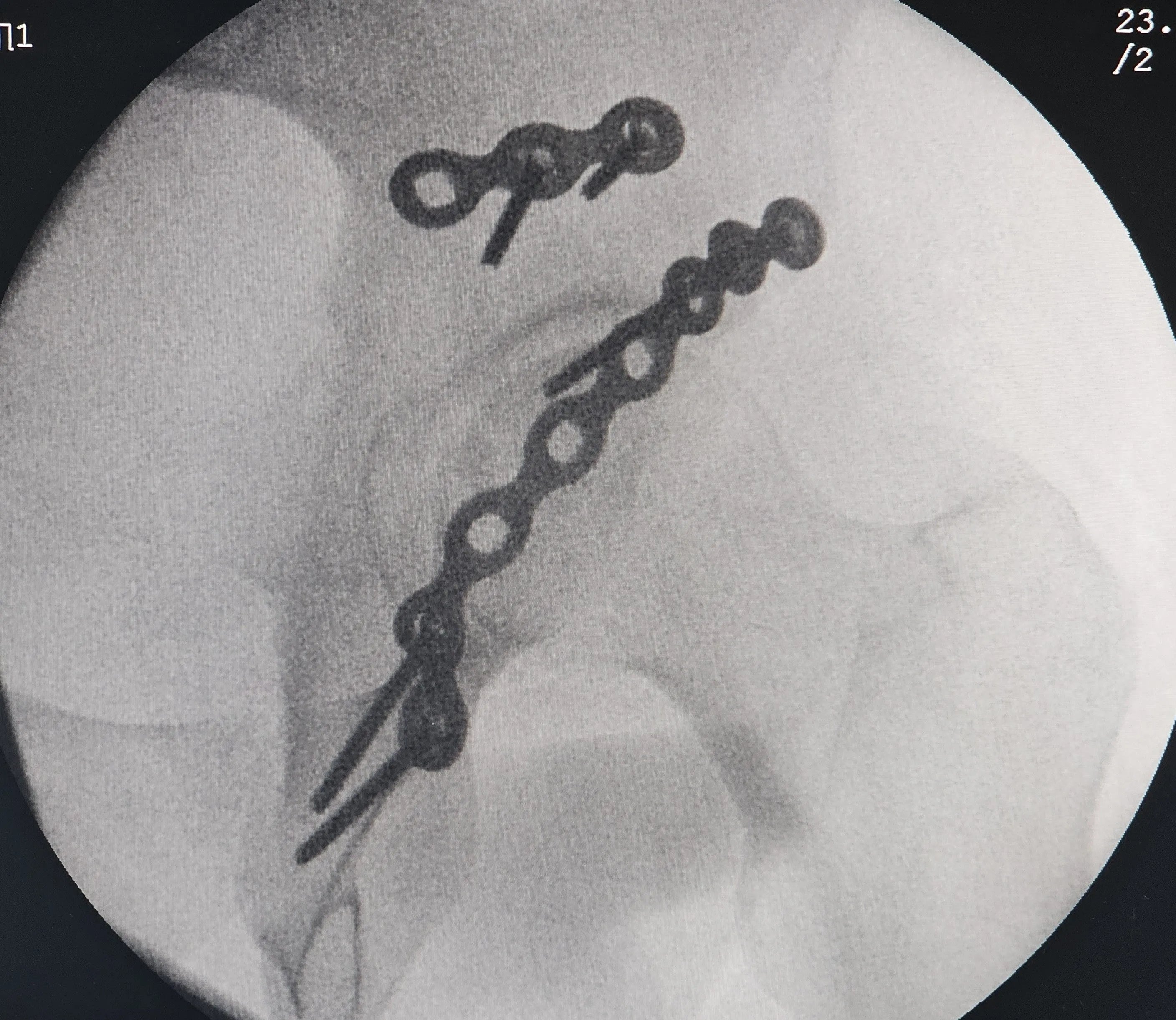 Fracture of the Posterior Acetabular Wall with Hip Dislocation