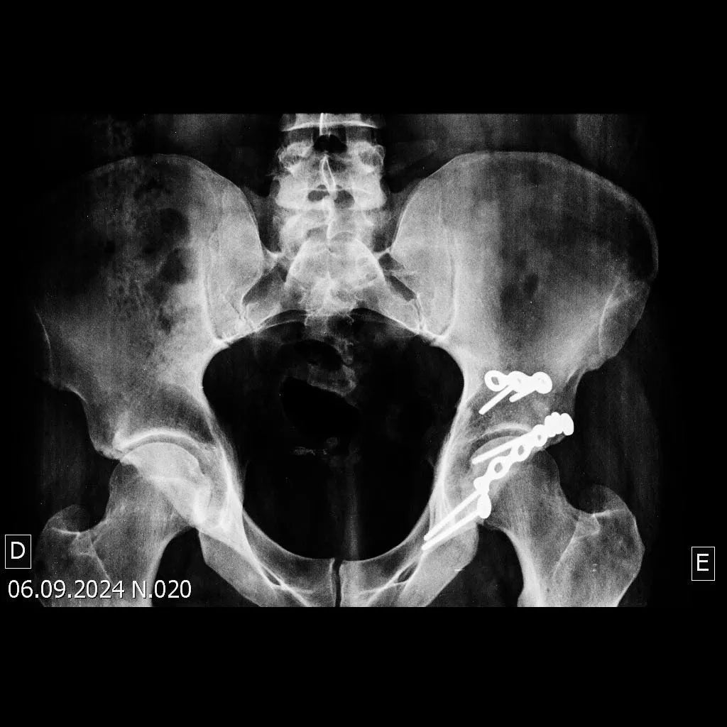 Fracture of the Posterior Acetabular Wall with Hip Dislocation