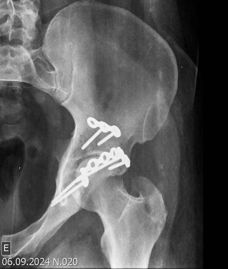 Fracture of the Posterior Acetabular Wall with Hip Dislocation