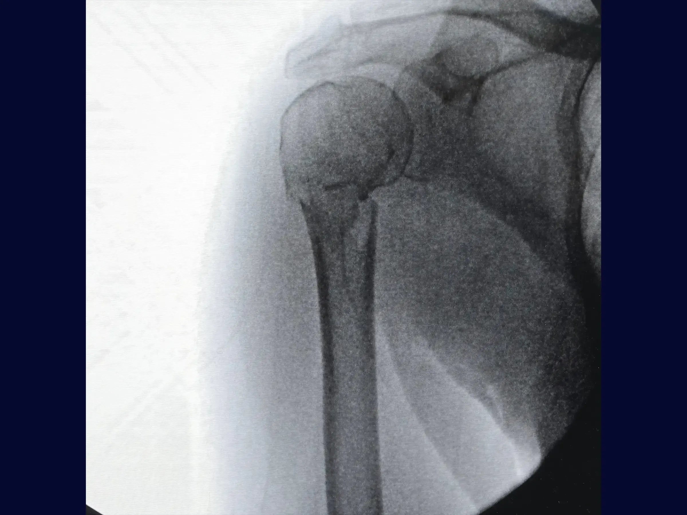 Fracture of the Proximal Humerus in 2 Parts (Deltopectoral Approach)