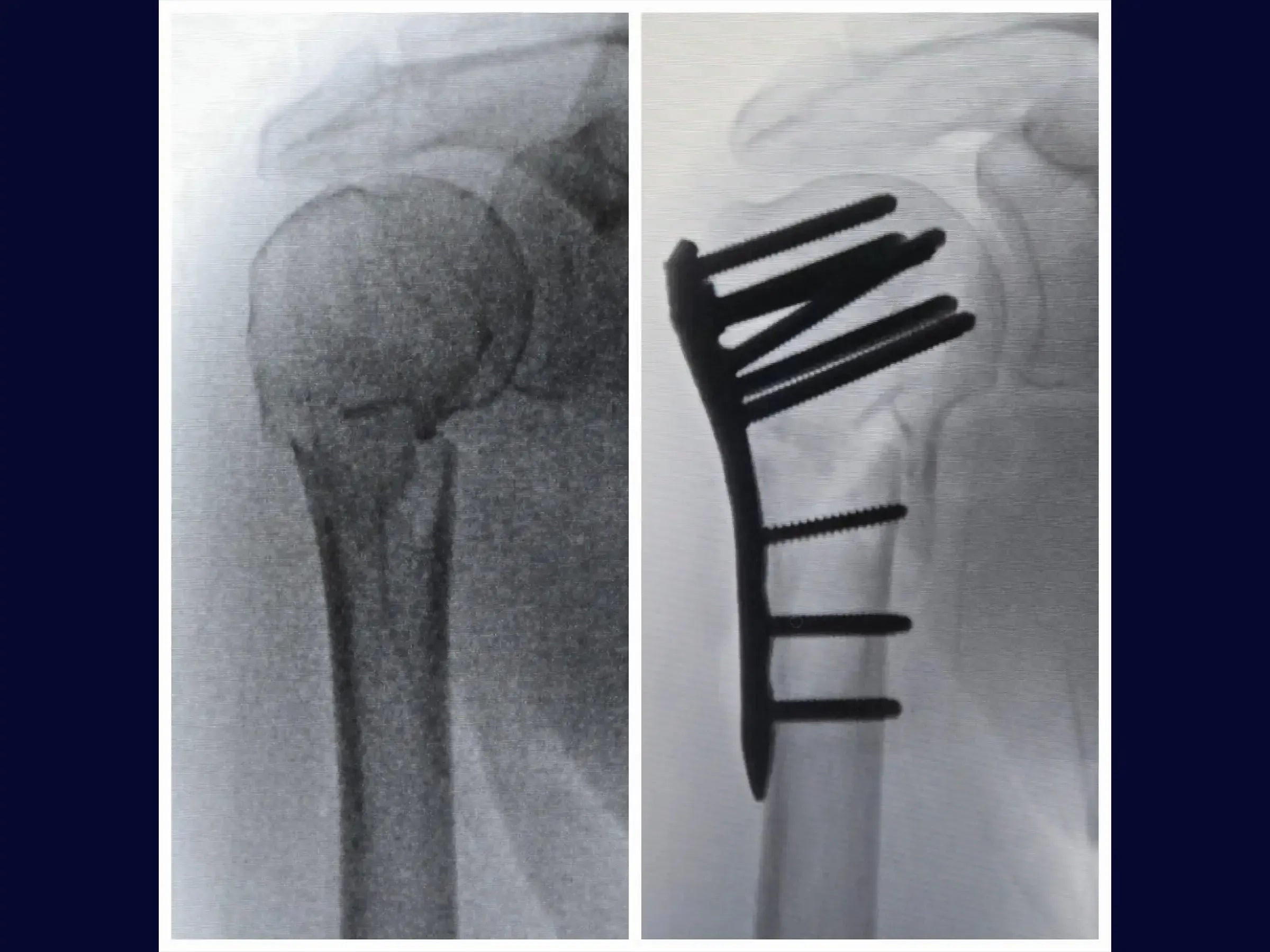 Fracture of the Proximal Humerus in 2 Parts (Deltopectoral Approach)