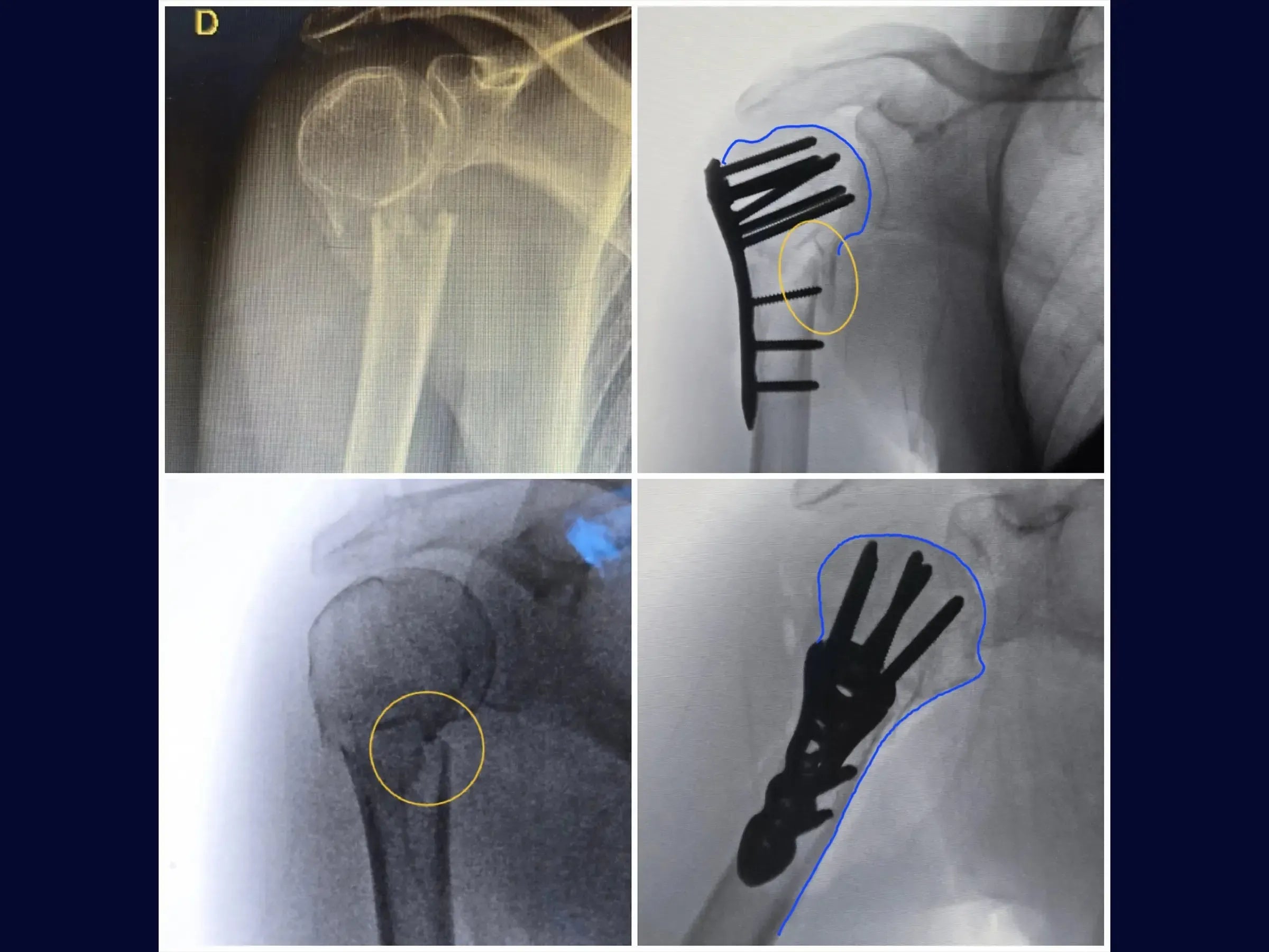 Fracture of the Proximal Humerus in 2 Parts (Deltopectoral Approach)