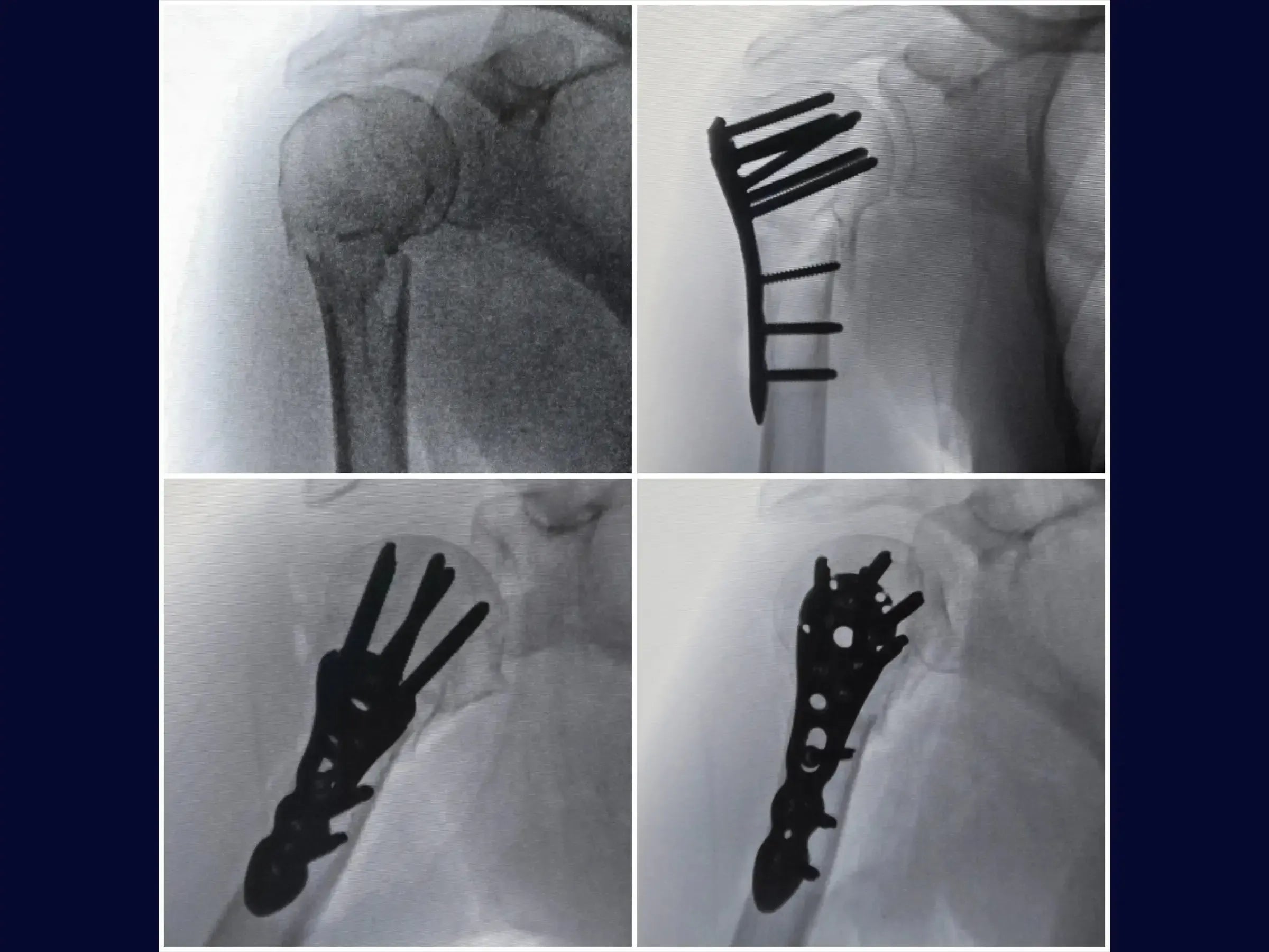 Fracture of the Proximal Humerus in 2 Parts (Deltopectoral Approach)