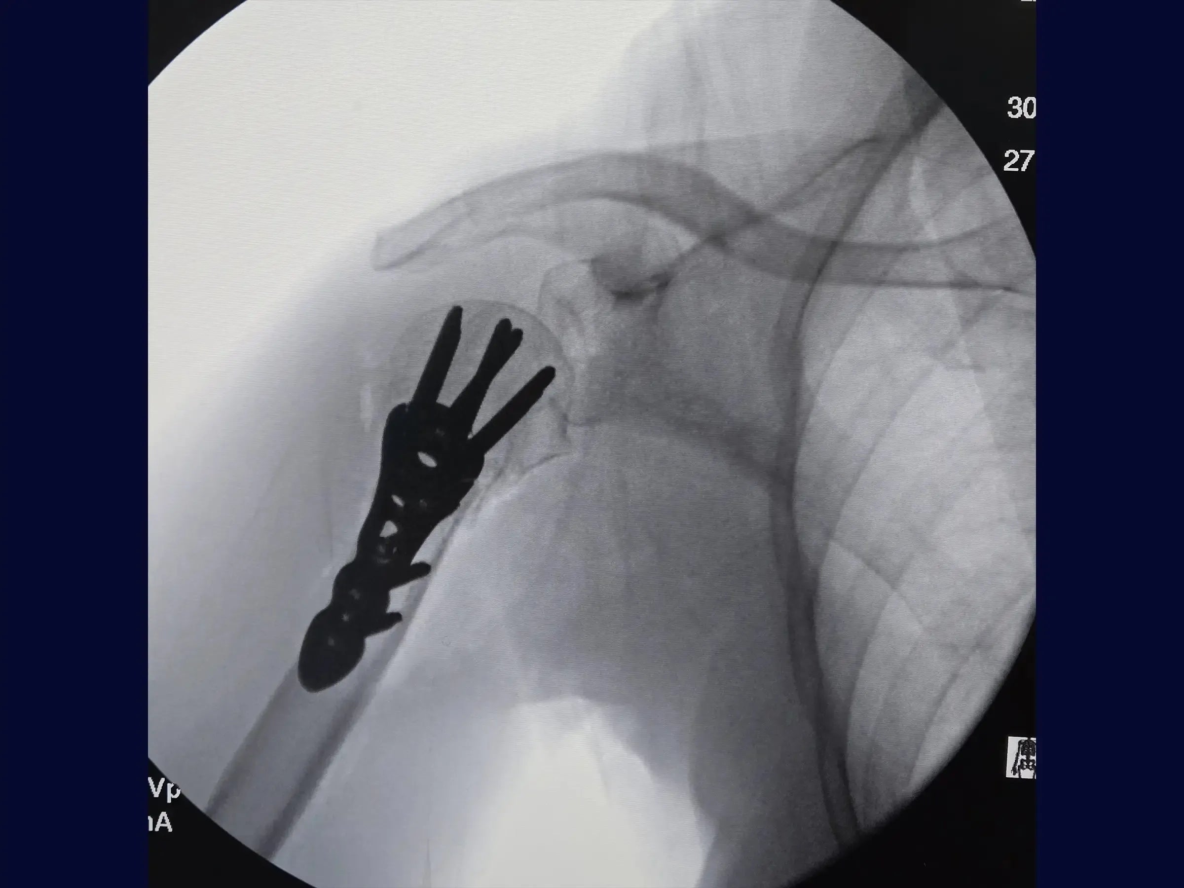 Fracture of the Proximal Humerus in 2 Parts (Deltopectoral Approach)