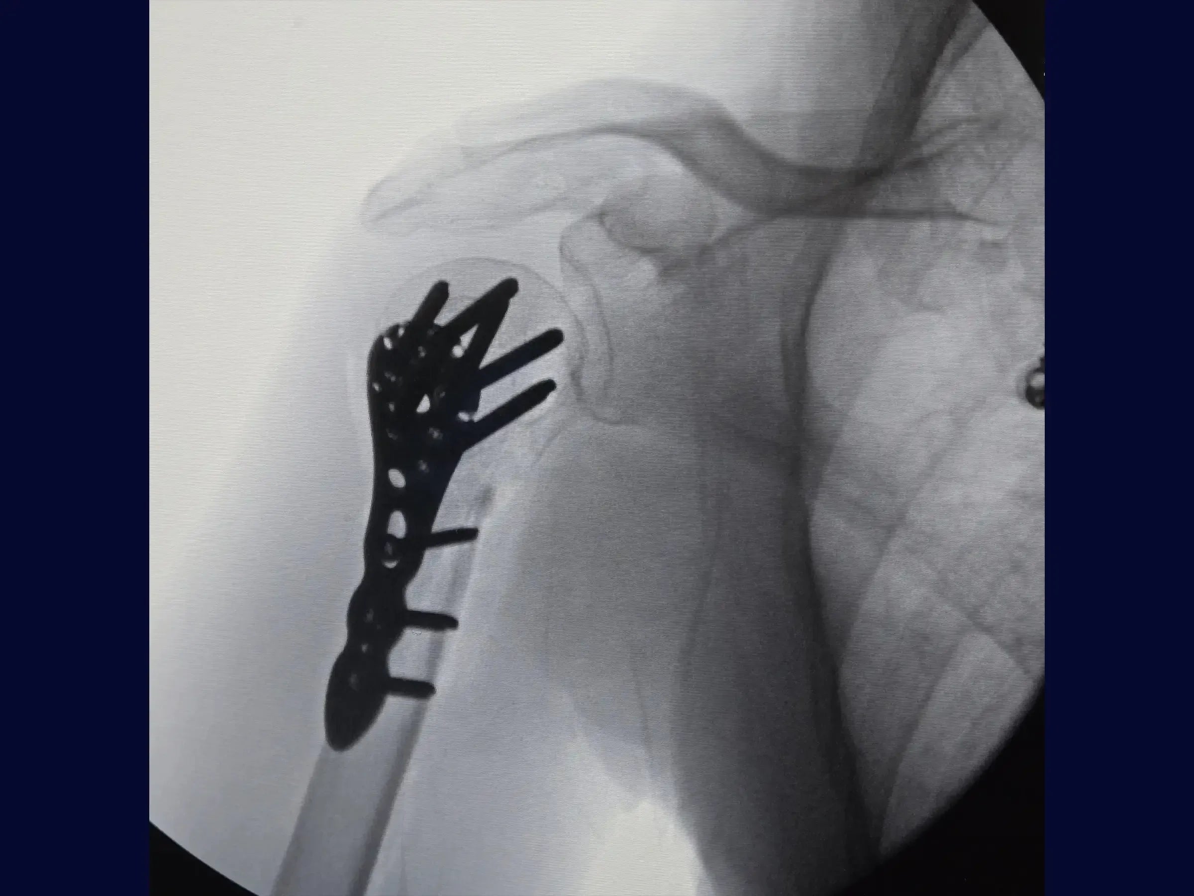 Fracture of the Proximal Humerus in 2 Parts (Deltopectoral Approach)