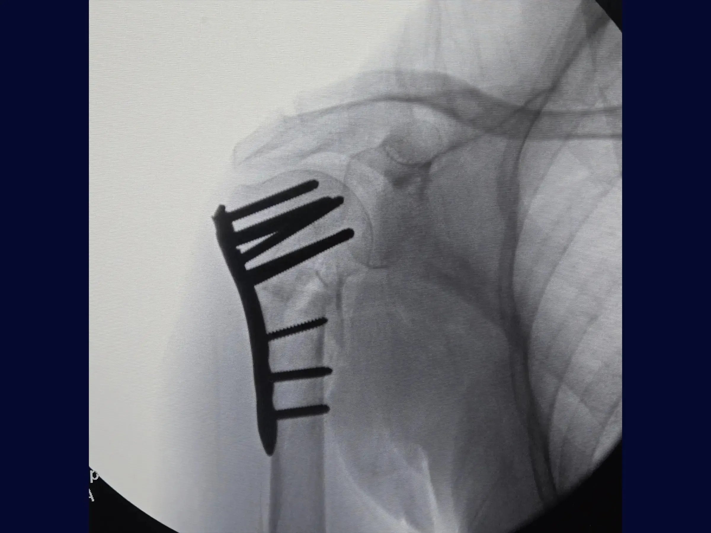 Fracture of the Proximal Humerus in 2 Parts (Deltopectoral Approach)