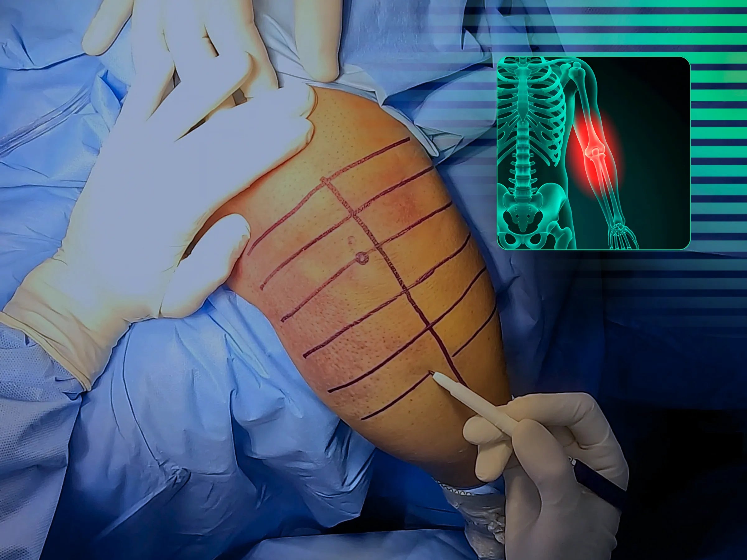 Transolecranon Fracture-Dislocation of the Elbow (Monteggia Variant) – "Pull-out" Technique