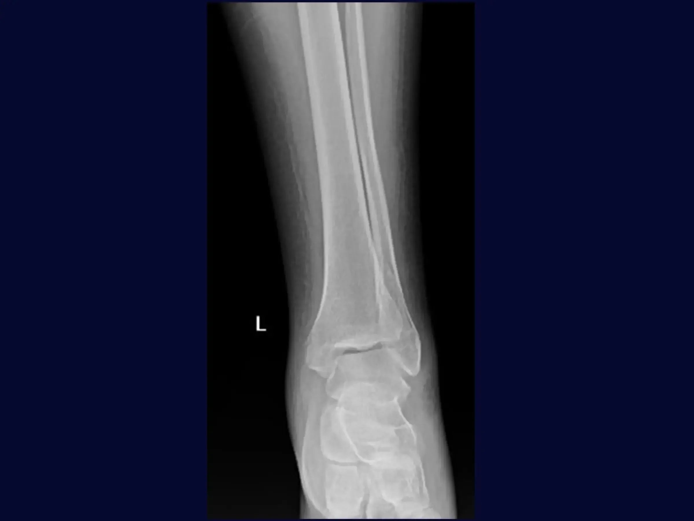 Fratura de Maléolo Lateral com Placa Posterior