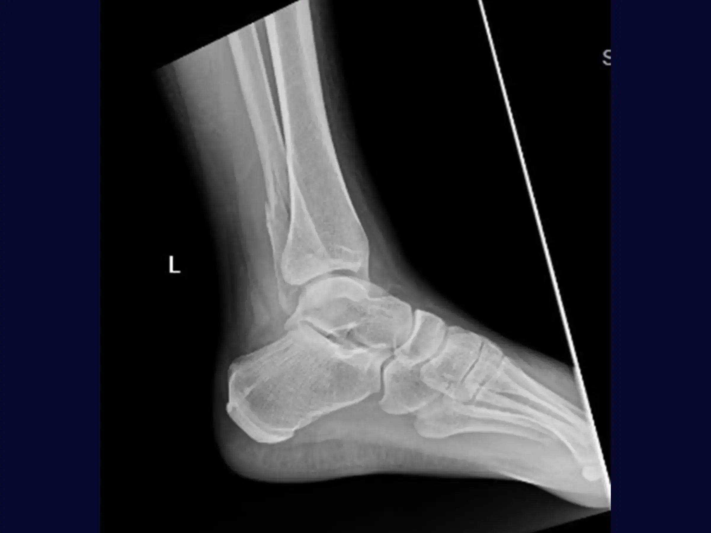 Fratura de Maléolo Lateral com Placa Posterior