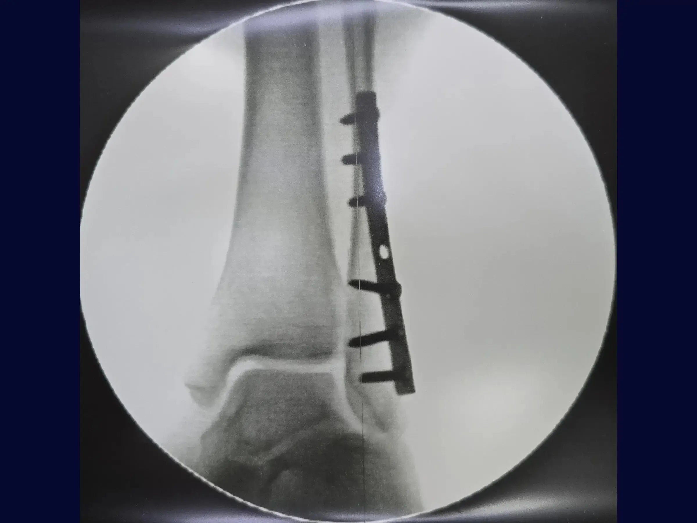 Fratura de Maléolo Lateral com Placa Posterior