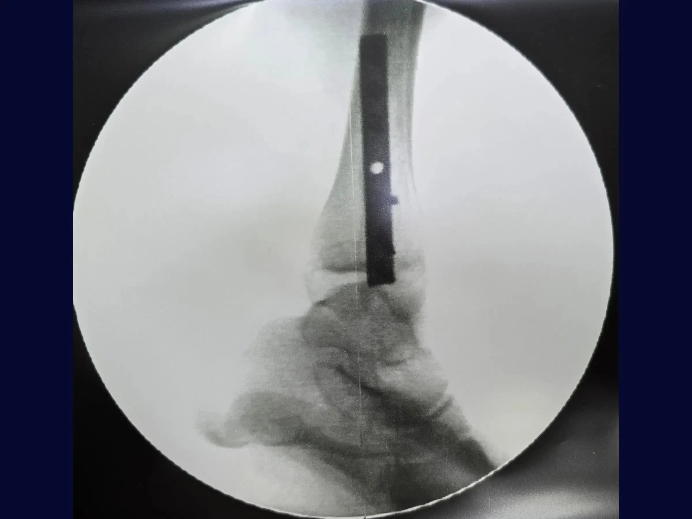 Fratura de Maléolo Lateral com Placa Posterior