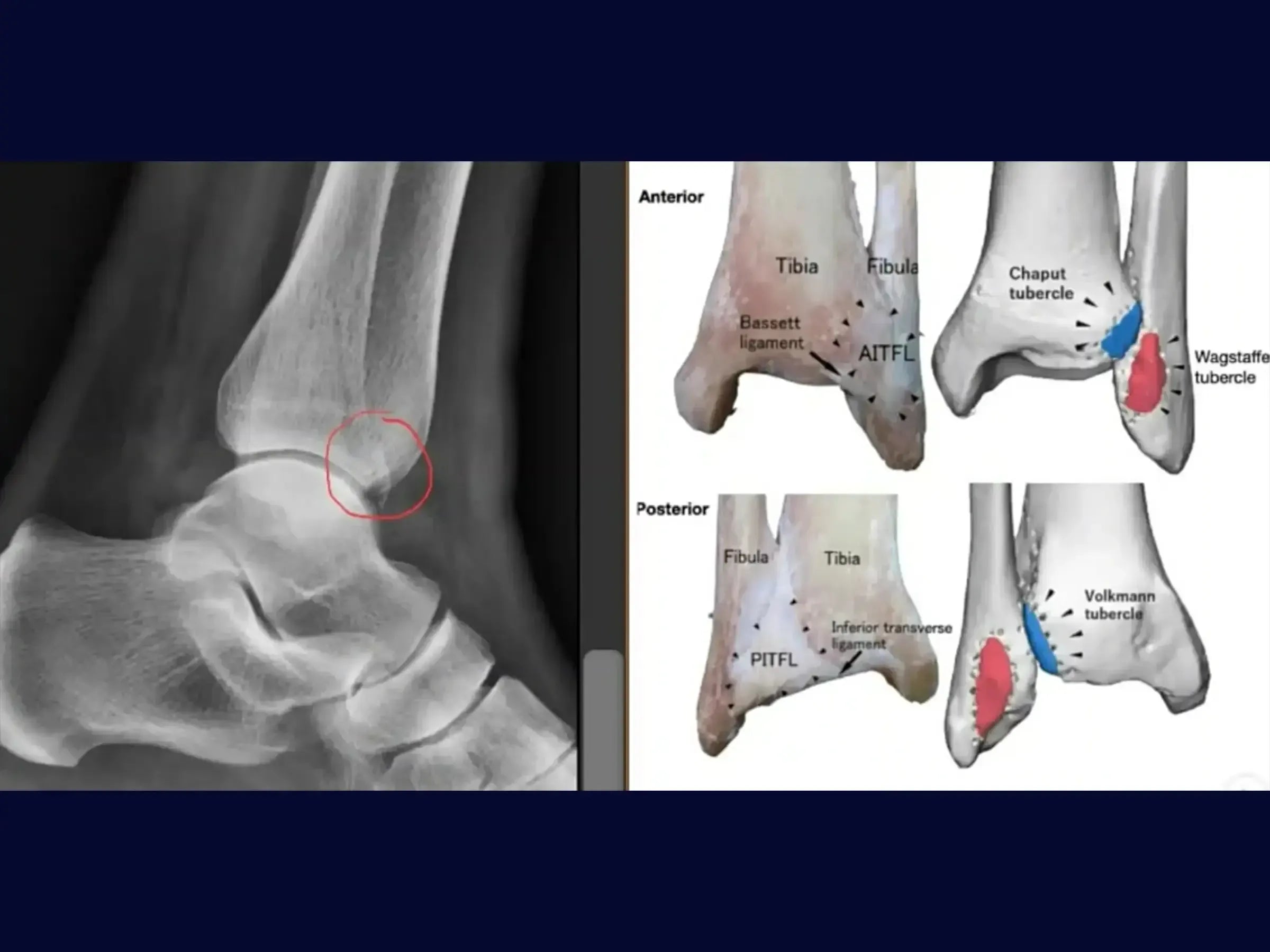 Fratura do Maléolo Lateral com Fragmento de Wagstaffe