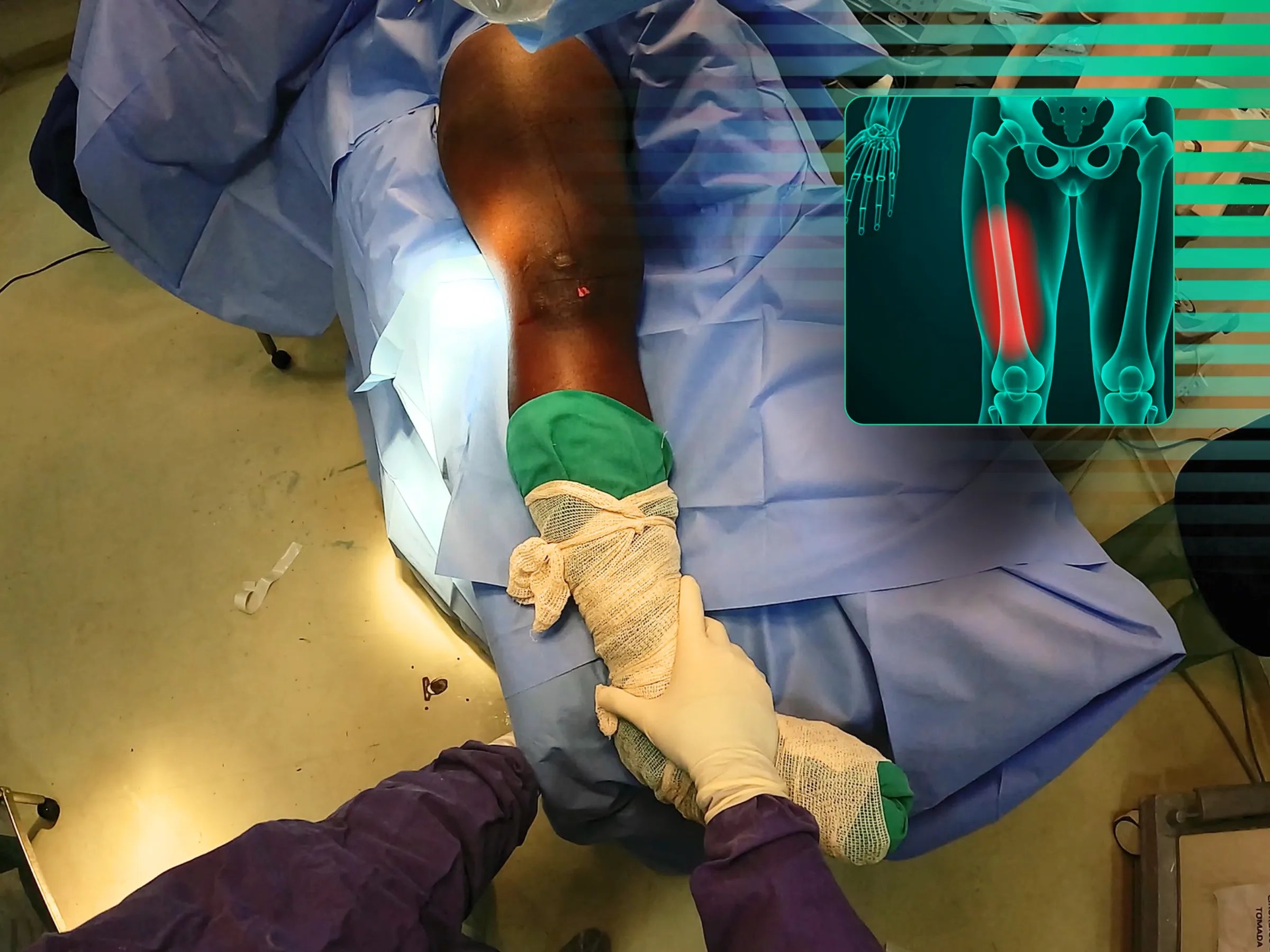 Fratura Diafisária de Fêmur - Haste Intramedular Retrógrada