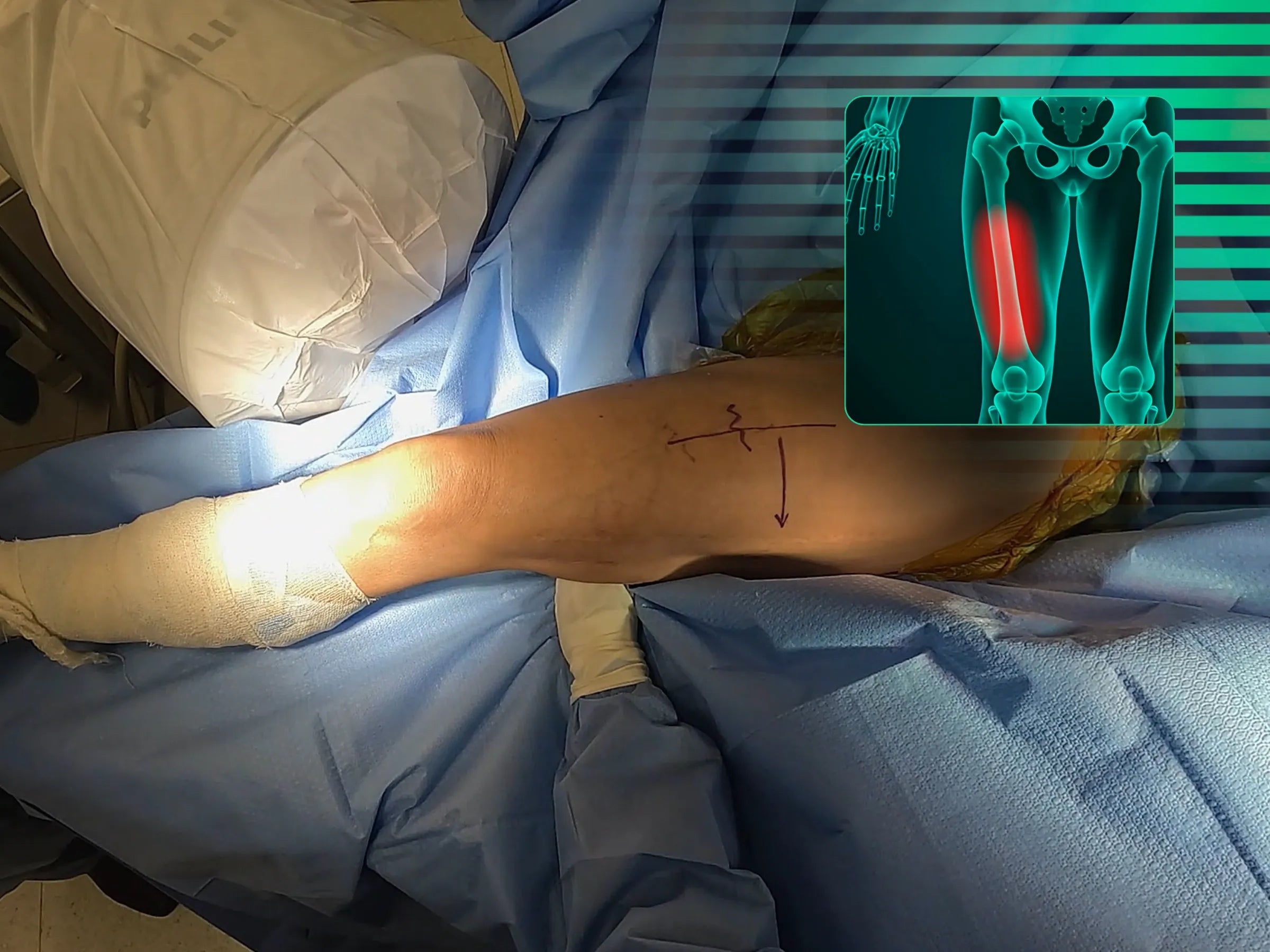 Fratura Diafisária do Fêmur - Haste Intramedular Anterógrada Cefalomedular