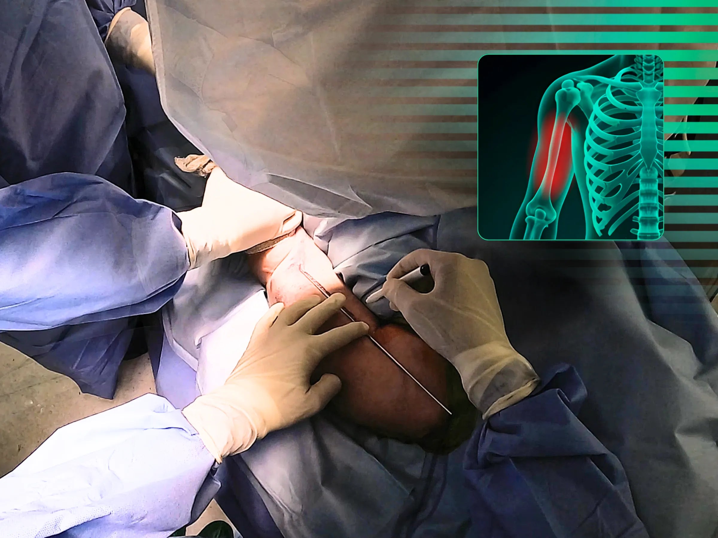 Diaphyseal Humerus Fracture - Treatment with Intramedullary Nail