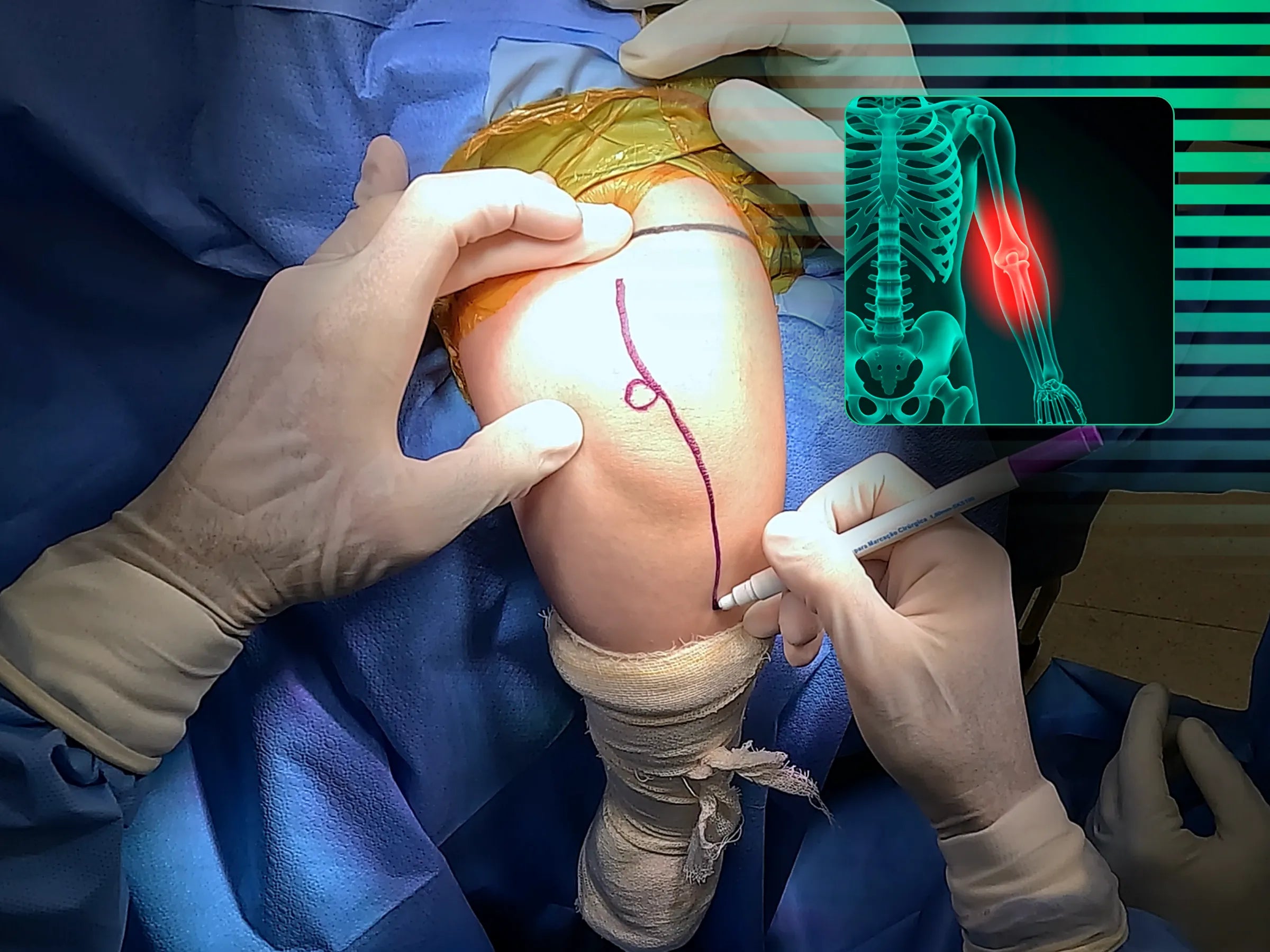 Fractura metafisaria del cúbito proximal con luxación y fractura de la cabeza radial (variante de Monteggia)