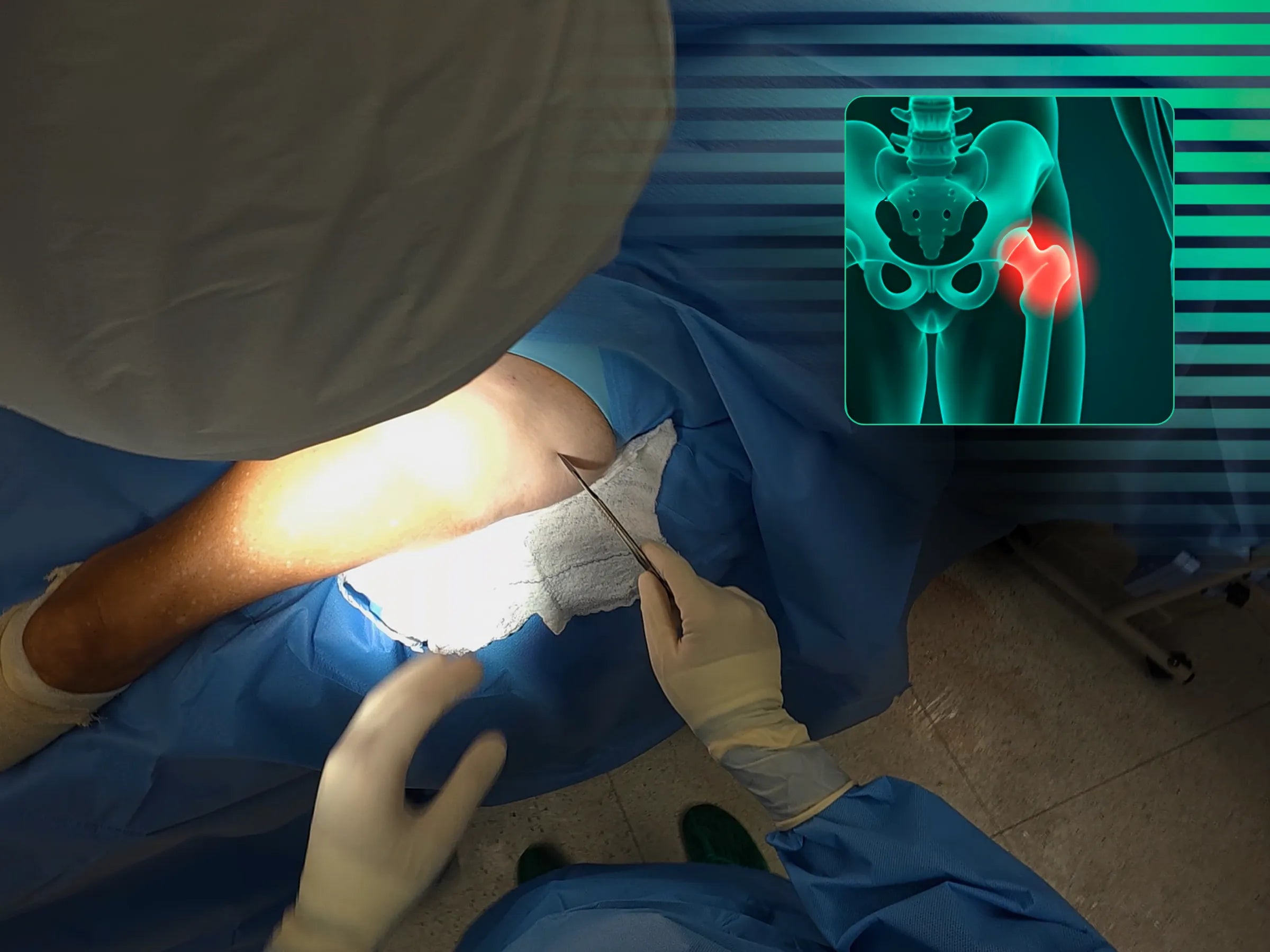 Fratura Transtrocanteriana com Haste Intramedular (Sem Mesa de Tração)