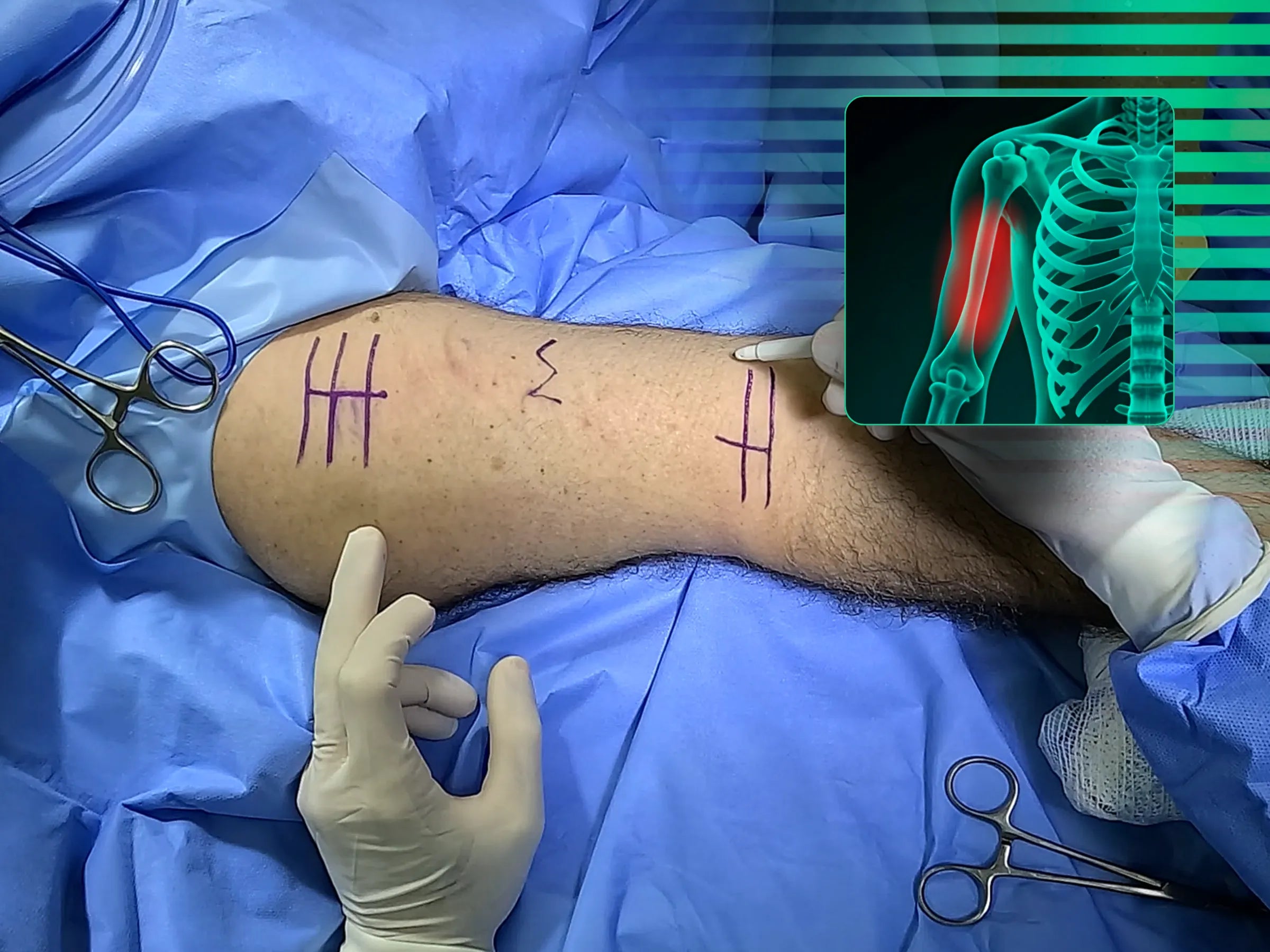 Fratura da Diáfise Umeral - Tratamento com Placa em Ponte