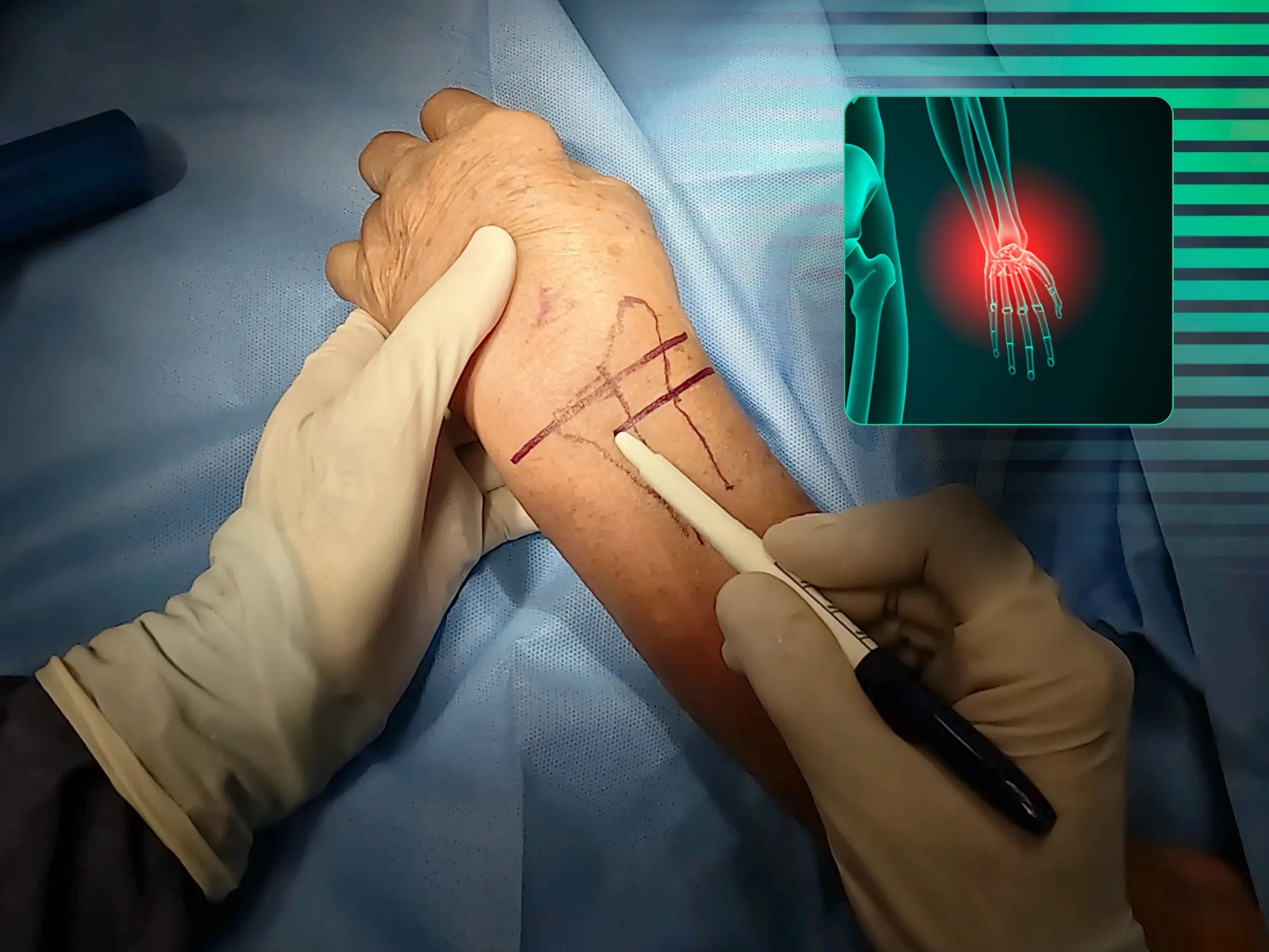 Fratura de Barton Dorsal do Rádio