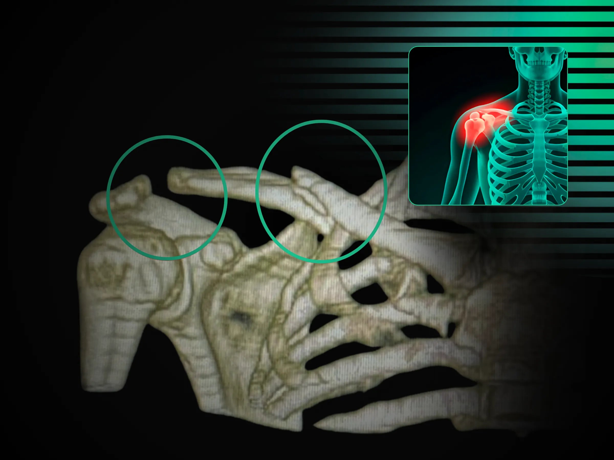 Fratura de Clavícula e Luxação Acromioclavicular Posterior