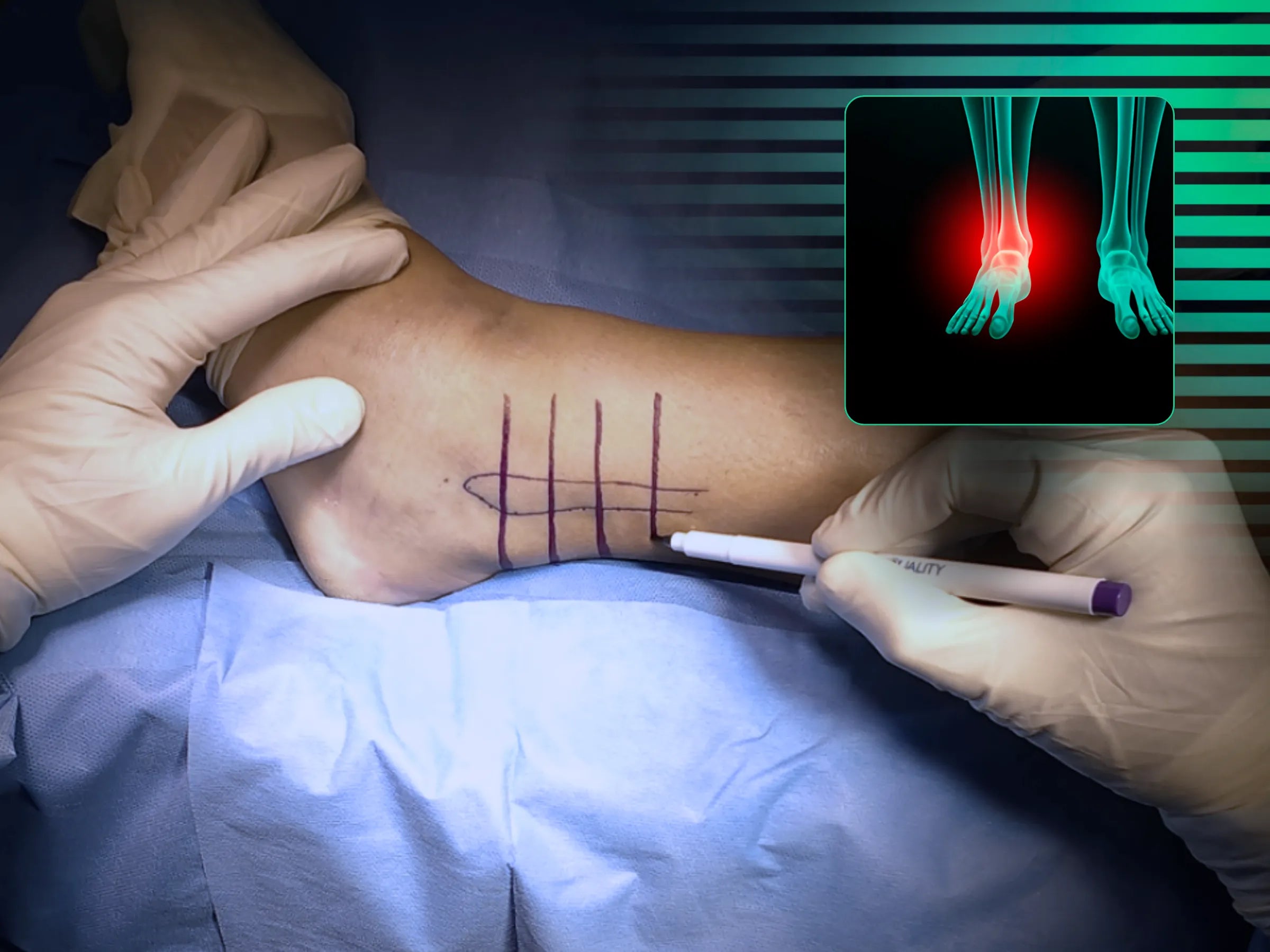 Fratura de Maléolo Lateral com Placa Posterior (Plano B)