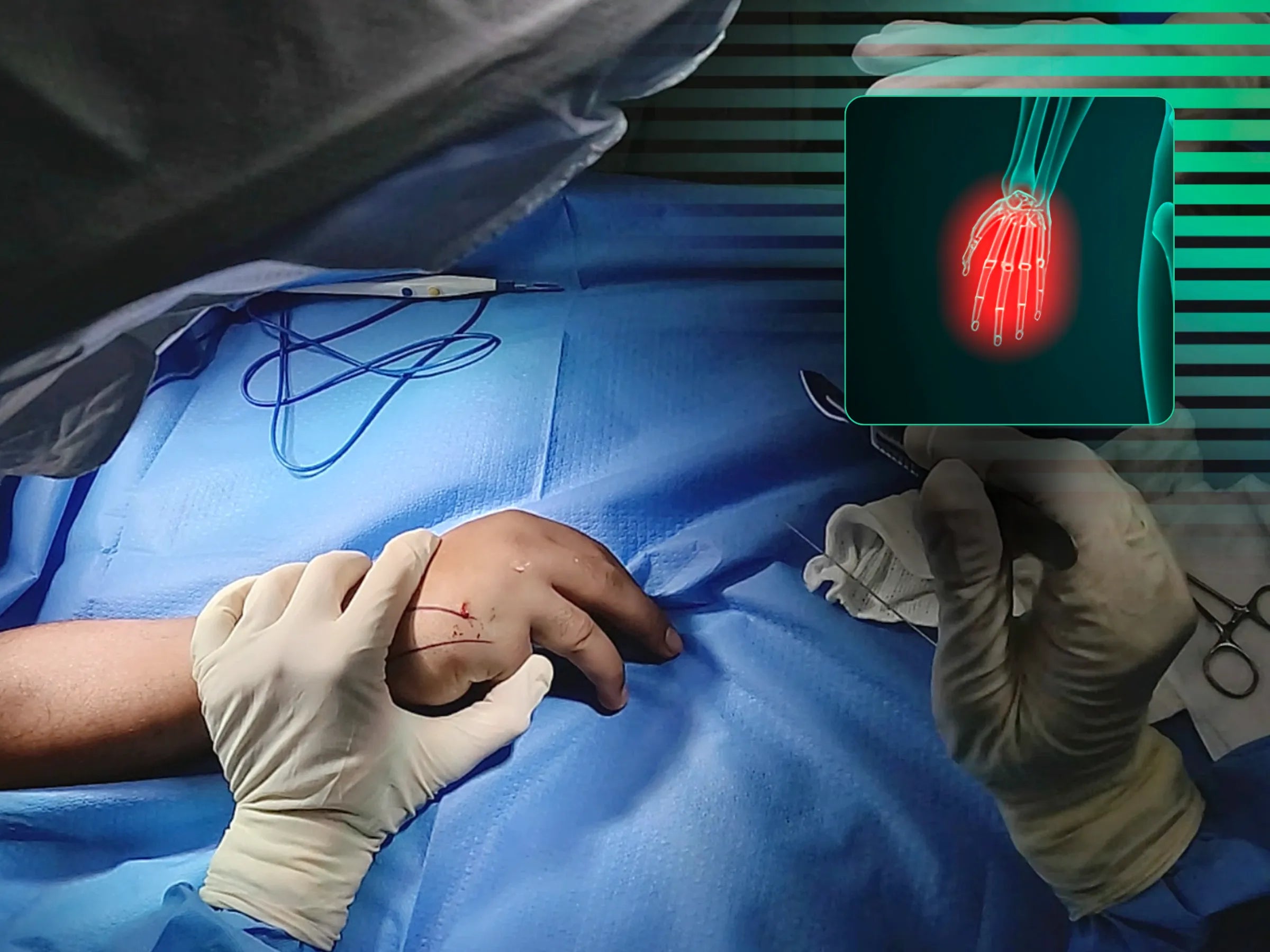 Fractura del cuello del quinto metacarpiano (fractura del boxeador)