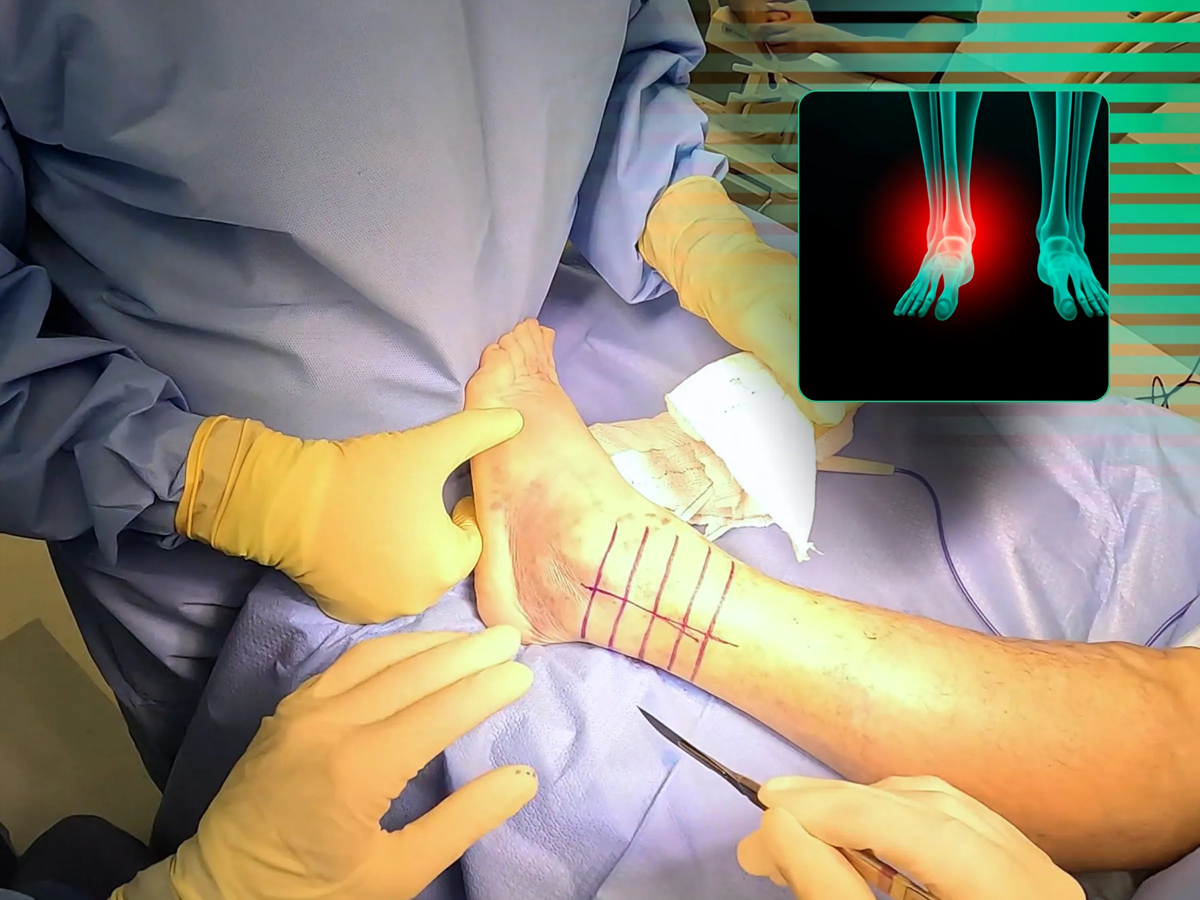 Fratura do Maléolo Lateral com Fragmento de Wagstaffe