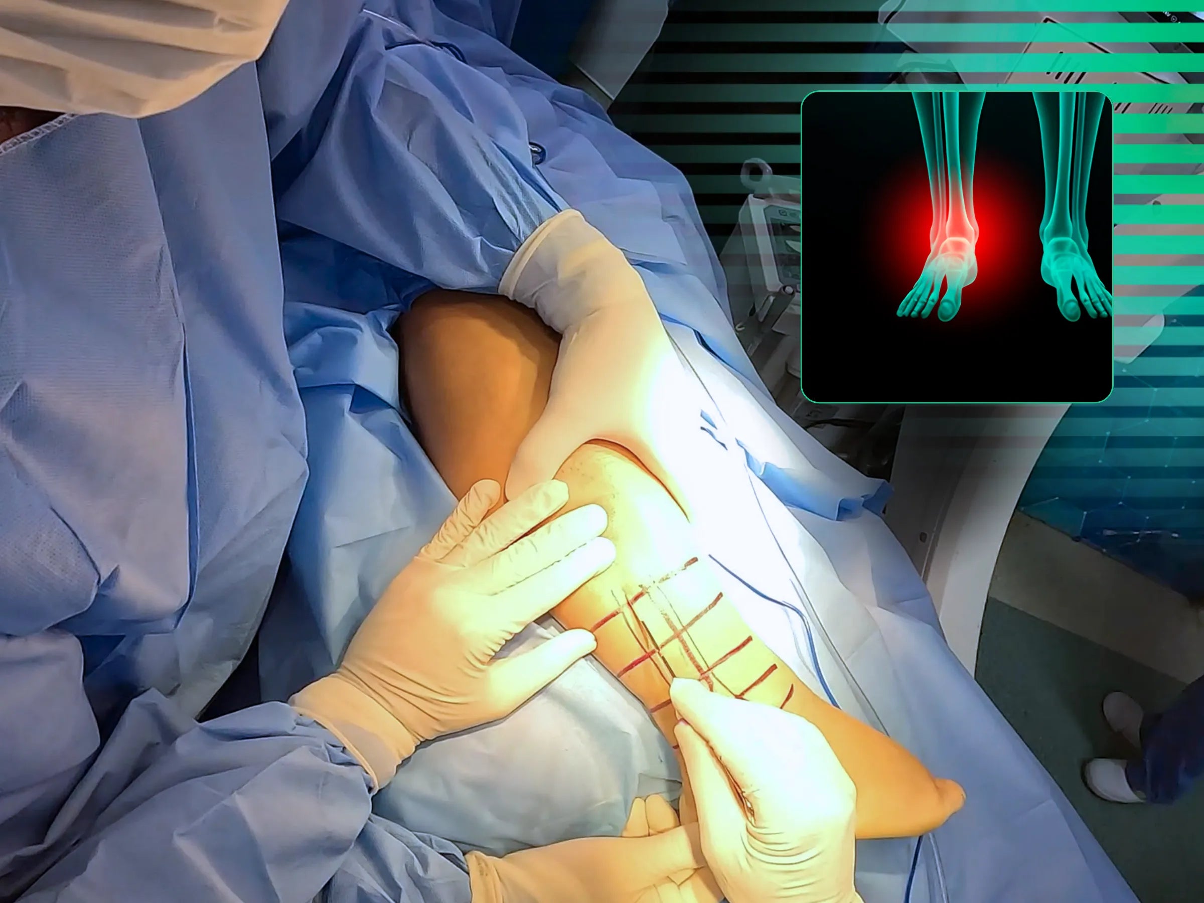 Fractura del maléolo posterior y del maléolo lateral (abordaje posterolateral único)